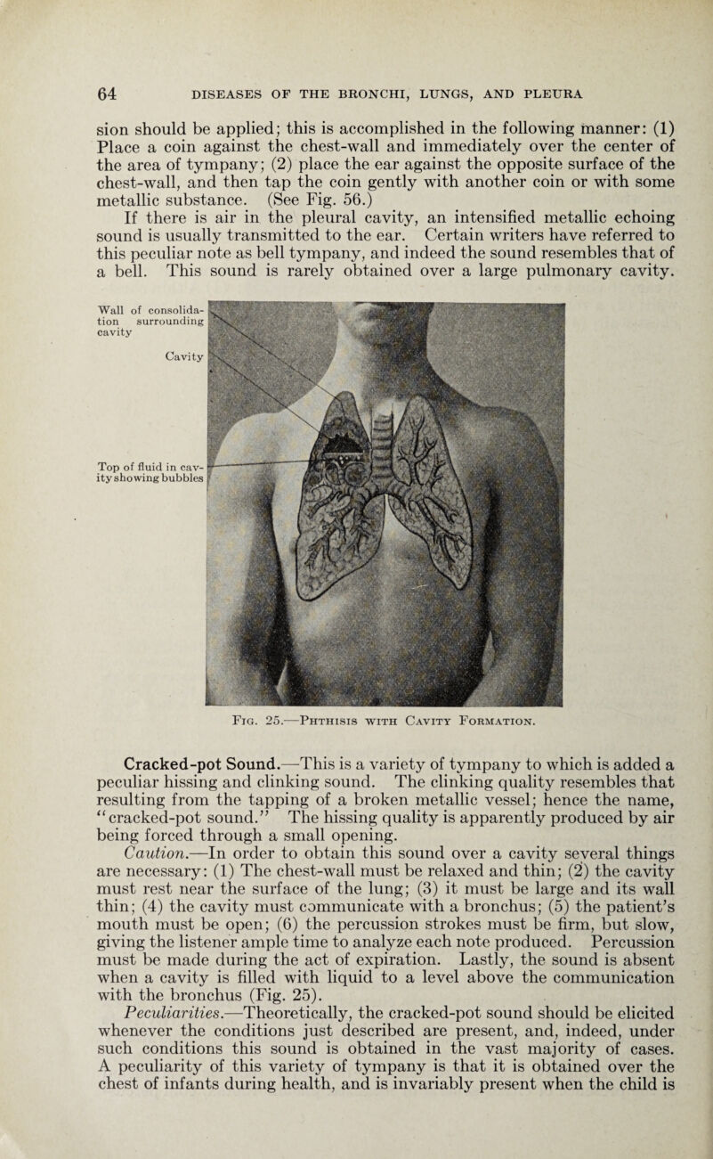 sion should be applied; this is accomplished in the following manner: (1) Place a coin against the chest-wall and immediately over the center of the area of tympany; (2) place the ear against the opposite surface of the chest-wall, and then tap the coin gently with another coin or with some metallic substance. (See Fig. 56.) If there is air in the pleural cavity, an intensified metallic echoing sound is usually transmitted to the ear. Certain writers have referred to this peculiar note as bell tympany, and indeed the sound resembles that of a bell. This sound is rarely obtained over a large pulmonary cavity. Wall of consolida¬ tion surrounding cavity Cavity Top of fluid in cav¬ ityshowing bubbles Fig. 25.—Phthisis with Cavity Formation. Cracked-pot Sound.—This is a variety of tympany to which is added a peculiar hissing and clinking sound. The clinking quality resembles that resulting from the tapping of a broken metallic vessel; hence the name, “cracked-pot sound.” The hissing quality is apparently produced by air being forced through a small opening. Caution.—In order to obtain this sound over a cavity several things are necessary: (1) The chest-wall must be relaxed and thin; (2) the cavity must rest near the surface of the lung; (3) it must be large and its wall thin; (4) the cavity must communicate with a bronchus; (5) the patient’s mouth must be open; (6) the percussion strokes must be firm, but slow, giving the listener ample time to analyze each note produced. Percussion must be made during the act of expiration. Lastly, the sound is absent when a cavity is filled with liquid to a level above the communication with the bronchus (Fig. 25). Peculiarities.—Theoretically, the cracked-pot sound should be elicited whenever the conditions just described are present, and, indeed, under such conditions this sound is obtained in the vast majority of cases. A peculiarity of this variety of tympany is that it is obtained over the chest of infants during health, and is invariably present when the child is