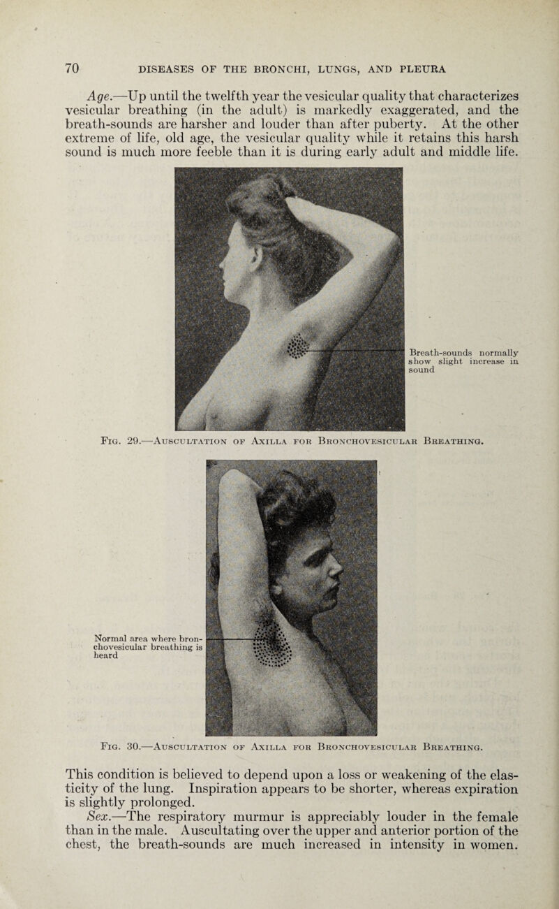 Age.—Up until the twelfth year the vesicular quality that characterizes vesicular breathing (in the adult) is markedly exaggerated, and the breath-sounds are harsher and louder than after puberty. At the other extreme of life, old age, the vesicular quality while it retains this harsh sound is much more feeble than it is during early adult and middle life. Breath-sounds normally show slight increase in sound Fig. 29.—Auscultation of Axilla for Bronchovesicular Breathing. This condition is believed to depend upon a loss or weakening of the elas¬ ticity of the lung. Inspiration appears to be shorter, whereas expiration is slightly prolonged. Sex.—The respiratory murmur is appreciably louder in the female than in the male. Auscultating over the upper and anterior portion of the chest, the breath-sounds are much increased in intensity in women.