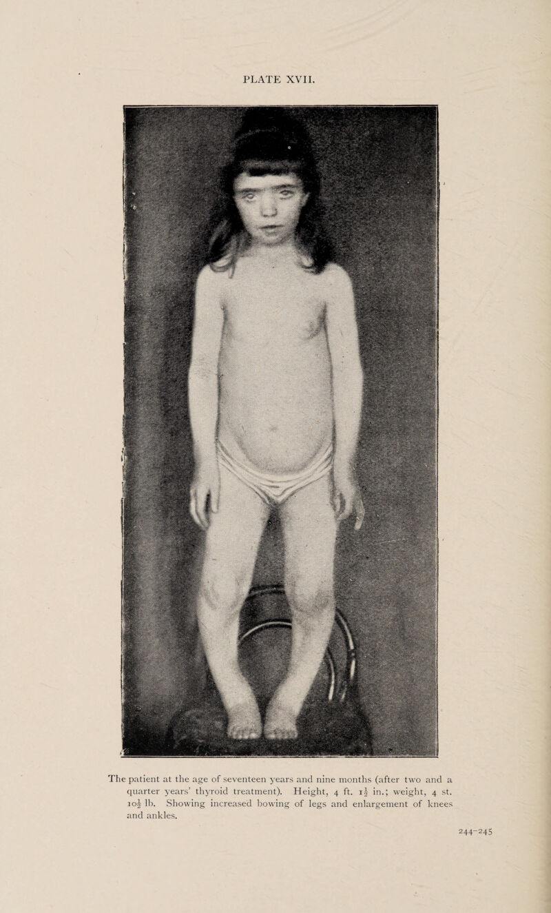 The patient at the age of seventeen years and nine months (after two and a quarter years’ thyroid treatment). Height, 4 ft. in.; weight, 4 st. 105 lb. Showing increased bowing of legs and enlargement of knees and ankles. 244-245