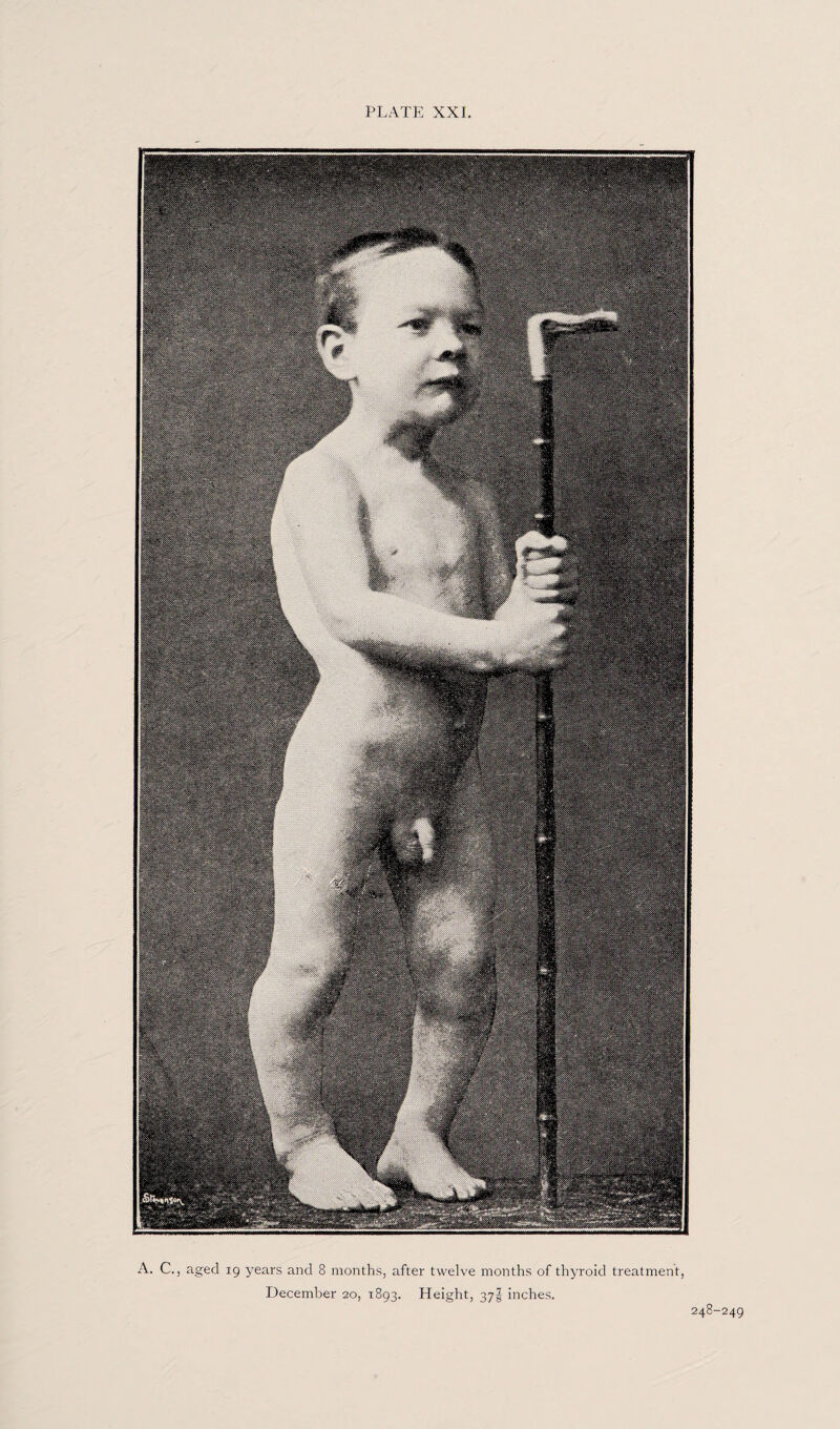 A. C., aged 19 years and 8 months, after twelve months of thyroid treatment, December 20, 1893. Height, 37! inches. 248-249