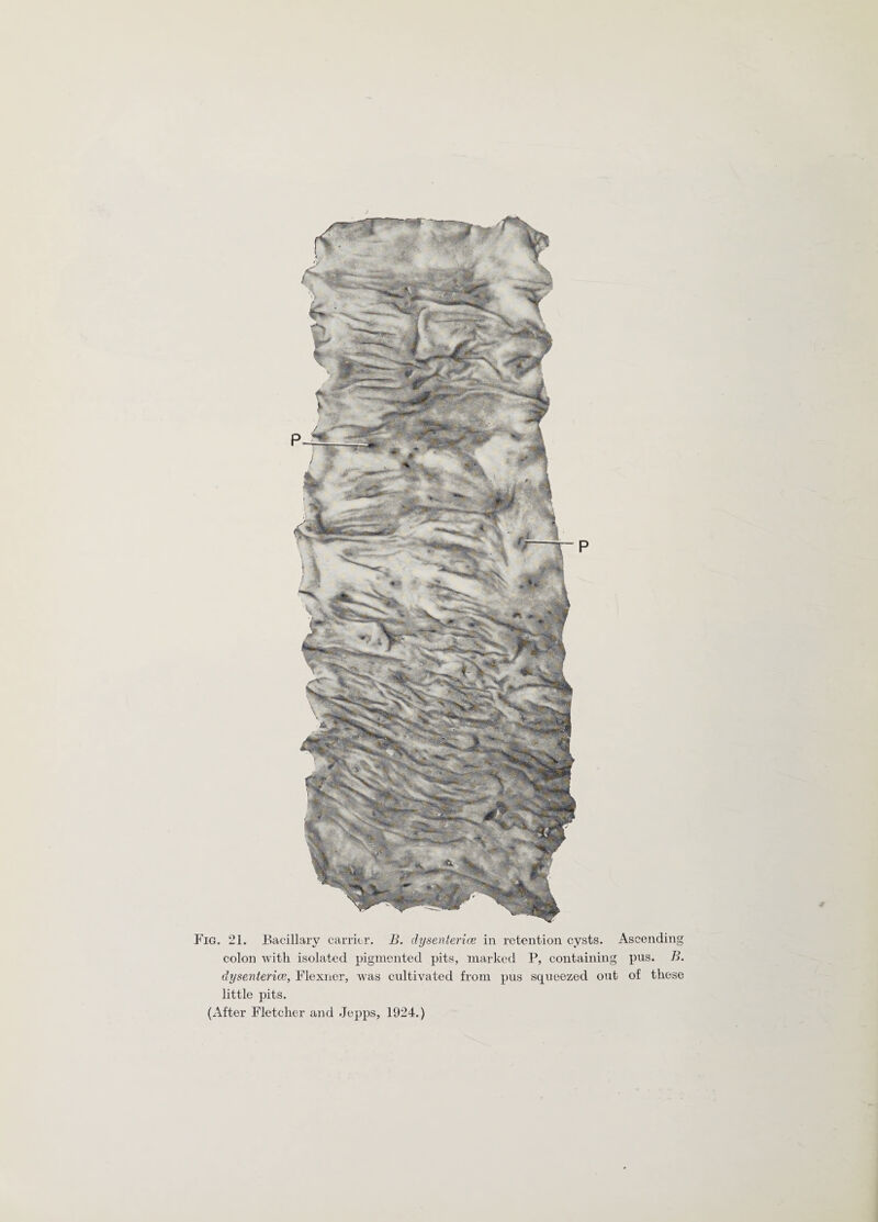 colon with isolated pigmented pits, marked P, containing pus. B. dysenteries, Flexner, was cultivated from pus squeezed out of these little pits.