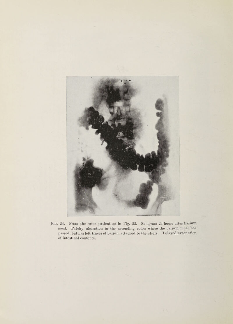 meal. Patchy ulceration in the ascending colon where the barium meal has passed, but has left traces of barium attached to the ulcers. Delayed evacuation of intestinal contents.