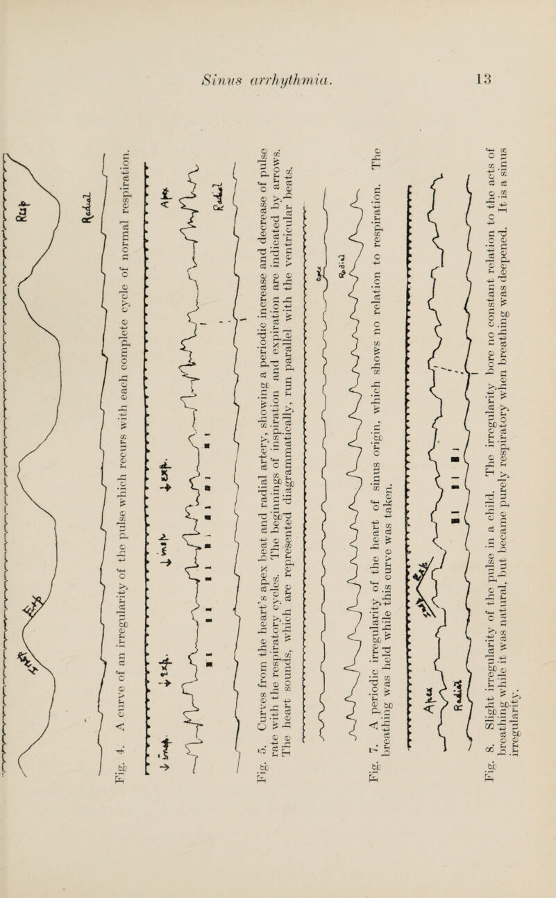 8. Slight irregularity of the pulse in a child. The irregularity bore no constant relation to the acts of breathing while it was natural, but became purely respiratory when breathing was deepened. It is a sinus irregularity. c? v