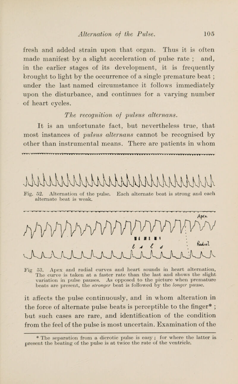 fresh and added strain upon that organ. Thus it is often made manifest by a slight acceleration of pulse rate ; and, in the earlier stages of its development, it is frequently brought to light by the occurrence of a single premature beat ; under the last named circumstance it follows immediately upon the disturbance, and continues for a varying number of heart cycles. The recognition of pulsus alter nans. It is an unfortunate fact, but nevertheless true, that most instances of pulsus alternans cannot be recognised by other than instrumental means. There are patients in whom vnn i » yr 9 v rfvrr»n> vwrvWTtiiTl y V yr >'>*Y f »T*T * Fig. 52. Alternation of the pulse. Each alternate beat is strong and each alternate beat is weak. V —-w—*—w—V t-V-V—v—V-V—W ■v  V —w—v—+—»—w—v-----v---«---«--—V——V->r-W 'V—v-u- Fig 53. Apex and radial curves and heart sounds in heart alternation, The curve is taken at a faster rate than the last and shows the slight variation in pulse pauses. As opposed to the picture when premature beats are present, the stronger beat is followed by the longer pause. it affects the pulse continuously, and in whom alteration in the force of alternate pulse beats is perceptible to the finger* ; but such cases are rare, and identification of the condition from the feel of the pulse is most uncertain. Examination of the * The separation from a dicrotic pulse is easy ; for where the latter is present the beating of the pulse is at twice the rate of the ventricle.