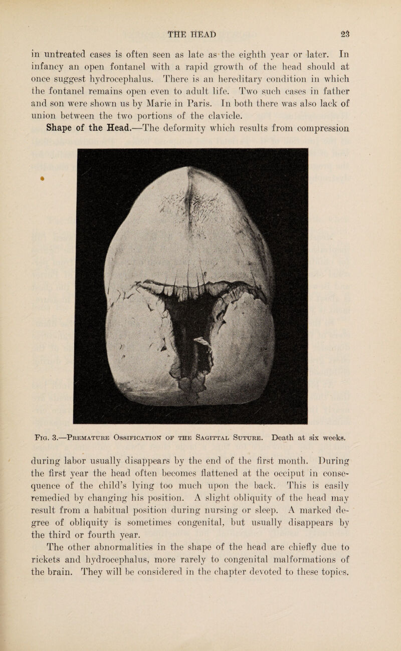 in untreated cases is often seen as late as the eighth year or later. In infancy an open fontanel with a rapid growth of the head should at once suggest hydrocephalus. There is an hereditary condition in which the fontanel remains open even to adult life. Two such cases in father and son were shown us by Marie in Paris. In both there was also lack of union between the two portions of the clavicle. Shape of the Head.—The deformity which results from compression Fig. 3.—Premature Ossification of the Sagittal Suture. Death at six weeks. during labor usually disappears by the end of the first month. During the first year the head often becomes flattened at the occiput in conse¬ quence of the child’s lying too much upon the back. This is easily remedied by changing his position. A slight obliquity of the head may result from a habitual position during nursing or sleep. A marked de¬ gree of obliquity is sometimes congenital, but usually disappears by the third or fourth year. The other abnormalities in the shape of the head are chiefly due to rickets and hydrocephalus, more rarely to congenital malformations of the brain. They will be considered in the chapter devoted to these topics.