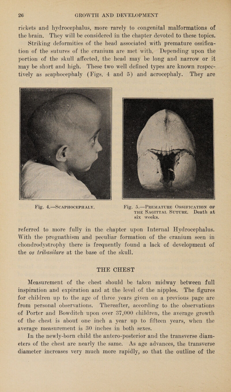 rickets and hydrocephalus, more rarely to congenital malformations of the brain. They will be considered in the chapter devoted to these topics. Striking deformities of the head associated with premature ossifica¬ tion of the sutures of the cranium are met with. Depending upon the portion of the skull affected, the head may be long and narrow or it may be short and high. These two well defined types are known respec¬ tively as scaphocephaly (Figs. 4 and 5) and acrocephaly. They are Fig. 4.—Scaphocephaly. Fig. 5.—Premature Ossification of the Sagittal Suture. Death at six weeks. referred to more fully in the chapter upon Internal Hydrocephalus. With the prognathism and peculiar formation of the cranium seen in chondrodystrophy there is frequently found a lack of development of the os tribasilare at the base of the skull. THE CHEST Measurement of the chest should be taken midway between full inspiration and expiration and at the level of the nipples. The figures for children up to the age of three years given on a previous page are from personal observations. Thereafter, according to the observations of Porter and Bowditch upon over 37,000 children, the average growth of the chest is about one inch a year up to fifteen years, when the average measurement is 30 inches in both sexes. In the newly-born child the antero-posterior and the transverse diam¬ eters of the chest are nearly the same. As age advances, the transverse diameter increases very much more rapidly, so that the outline of the