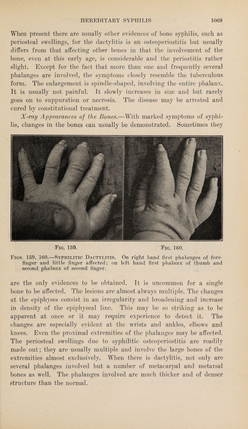 When present there are usually other evidences of bone syphilis, such as periosteal swellings, for the dactylitis is an osteoperiostitis but usually differs from that affecting other bones in that the involvement of the bone, even at this early age, is considerable and the periostitis rather slight. Except for the fact that more than one and frequently several phalanges are involved, the symptoms closely resemble the tuberculous form. The enlargement is spindle-shaped, involving the entire phalanx. It is usually not painful. It slowly increases in size and but rarely goes on to suppuration or necrosis. The disease may be arrested and cured by constitutional treatment. X-ray Appearances of the Bones.—With marked symptoms of syphi¬ lis, changes in the bones can usually be demonstrated. Sometimes they Fig. 159. Fig. 160. Figs. 159, 160.—Syphilitic DacTywitis. On right hand first phalanges of fore¬ finger and little finger affected; on left hand first phalanx of thumb and second phalanx of second finger. are the only evidences to be obtained. It is uncommon for a single bone to be affected. The lesions are almost always multiple. The changes at the epiphyses consist in an irregularity and broadening and increase in density of the epiphyseal line. This may be so striking as to be apparent at once or it may require experience to detect it. The changes are especially evident at the wrists and ankles, elbows and knees. Even the proximal extremities of the phalanges may be affected. The periosteal swellings due to syphilitic osteoperiostitis are readily made out; they are usually multiple and involve the large bones of the extremities almost exclusively. When there is dactylitis, not only are several phalanges involved but a number of metacarpal and metarsal bones as well. The phalanges involved are much thicker and of denser structure than the normal.