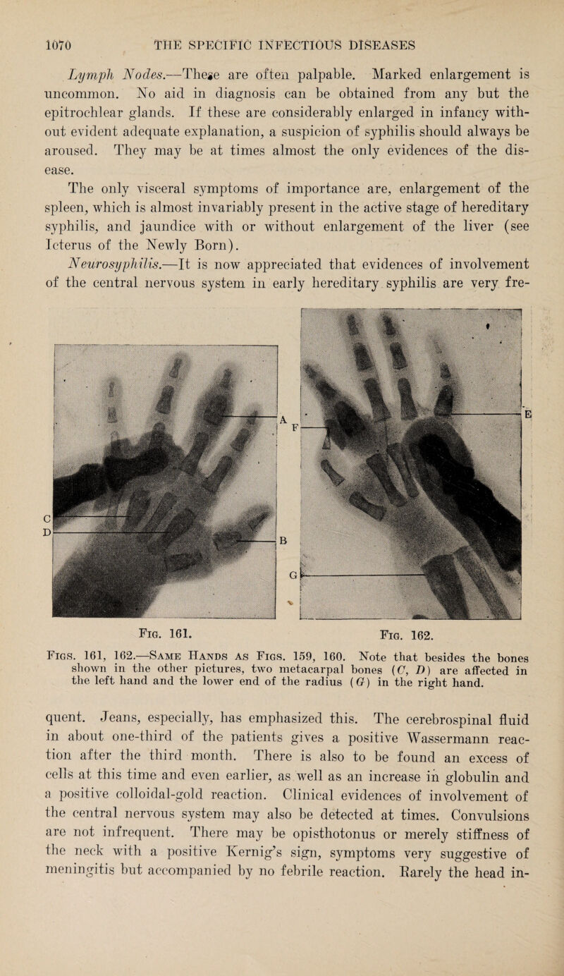 Lymph Nodes.—These are often palpable. Marked enlargement is uncommon. No aid in diagnosis can be obtained from any but the epitrochlear glands. If these are considerably enlarged in infancy with¬ out evident adequate explanation, a suspicion of syphilis should always be aroused. They may be at times almost the only evidences of the dis¬ ease. The only visceral symptoms of importance are, enlargement of the spleen, which is almost invariably present in the active stage of hereditary syphilis, and jaundice with or without enlargement of the liver (see Icterus of the Newly Born). Neuro syphilis.—It is now appreciated that evidences of involvement of the central nervous system in early hereditary syphilis are very fre- E Fig. 161. Fig. 162. Figs. 161, 162.—Same Hands as Figs. 159, 160. Note that besides the bones shown in the other pictures, two metacarpal bones (C, D) are affected in the left hand and the lower end of the radius (G) in the right hand. quent. Jeans, especially, has emphasized this. The cerebrospinal fluid in about one-third of the patients gives a positive Wassermann reac¬ tion after the third month. There is also to be found an excess of cells at this time and even earlier, as well as an increase in globulin and a positive colloidal-gold reaction. Clinical evidences of involvement of the central nervous system may also be detected at times. Convulsions are not infrequent. There may be opisthotonus or merely stiffness of the neck with a positive Kernig’s sign, symptoms very suggestive of meningitis but accompanied by no febrile reaction. Rarely the head in-