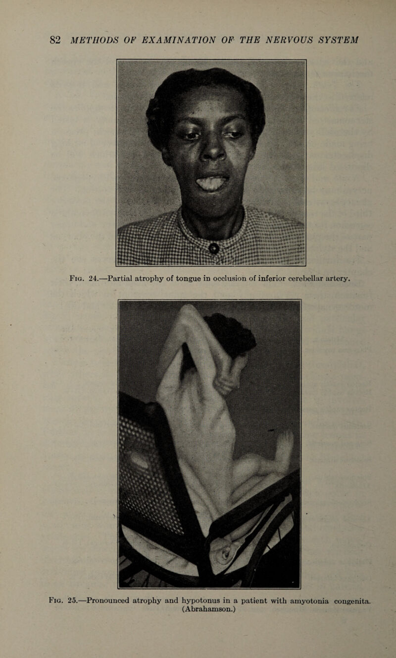 Fig. 24.—Partial atrophy of tongue in occlusion of inferior cerebellar artery. Fig. 25.—Pronounced atrophy and hypotonus in a patient with amyotonia congenita. (Abrahamson.)