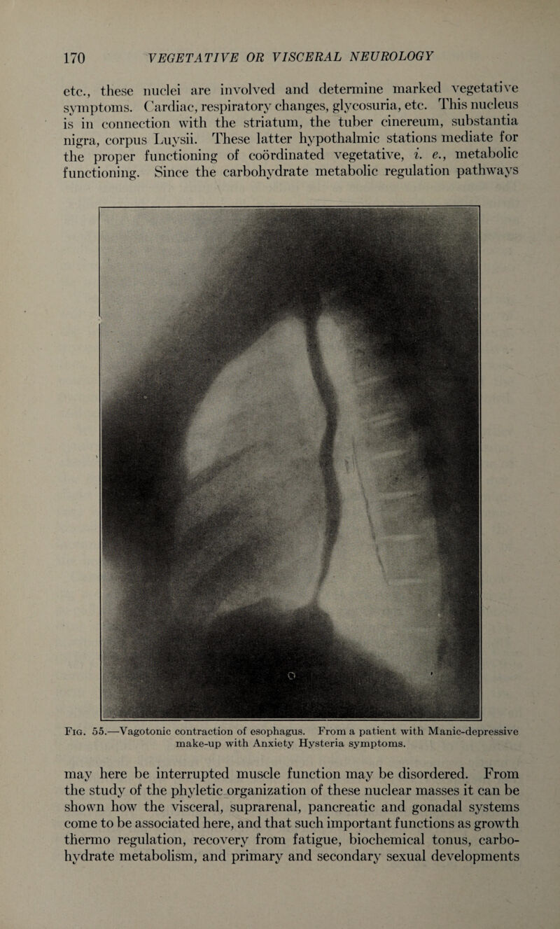 etc., these nuclei are involved and determine marked vegetative symptoms. Cardiac, respiratory changes, glycosuria, etc. This nucleus is in connection with the striatum, the tuber cinereum, substantia nigra, corpus Luysii. These latter hypothalmic stations mediate for the proper functioning of coordinated vegetative, i. e., metabolic functioning. Since the carbohydrate metabolic regulation pathways Fig. 55.—Vagotonic contraction of esophagus. From a patient with Manic-depressive make-up with Anxiety Hysteria symptoms. may here be interrupted muscle function may be disordered. From the study of the phyletic organization of these nuclear masses it can be shown how the visceral, suprarenal, pancreatic and gonadal systems come to be associated here, and that such important functions as growth thermo regulation, recovery from fatigue, biochemical tonus, carbo¬ hydrate metabolism, and primary and secondary sexual developments