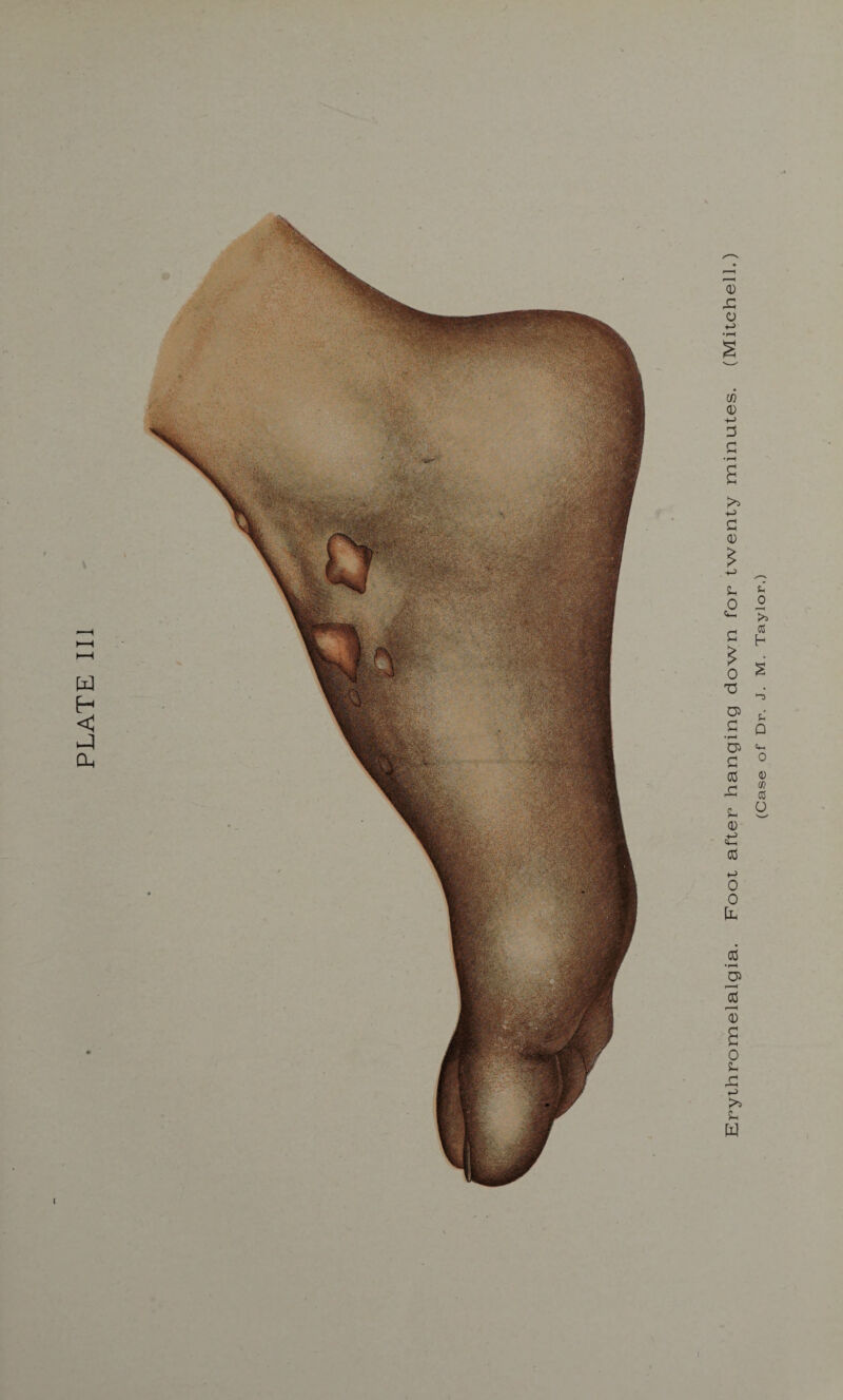 PLATE III Erythromelalgia. Foot after hanging down for twenty minutes. (Mitchell.) (Case of Dr. J. M. Taylor.)