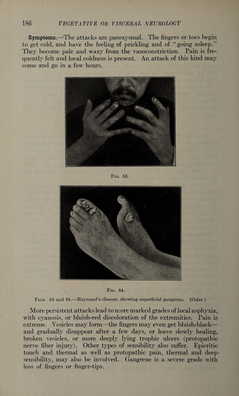 Symptoms.—The' attacks are paroxysmal. The fingers or toes begin to get cold, and have the feeling of prickling and of “going asleep.” They become pale and waxy from the vasoconstriction. Pain is fre¬ quently felt and local coldness is present. An attack of this kind may come and go in a few hours. Fig. 63. Fig. 64. Figs. 63 and 64.—Raynaud’s disease, showing superficial gangrene. (Osier.) More persistent attacks lead to more marked grades of local asphyxia, with cyanosis, or bluish-red discoloration of the extremities. Pain is extreme. Vesicles may form—the fingers may even get bluish-black— and gradually disappear after a few days, or leave slowly healing, broken vesicles, or more deeply lying trophic ulcers (protopathic nerve fiber injury). Other types of sensibility also suffer. Epicritic touch and thermal as well as protopathic pain, thermal and deep- sensibility, may also be involved. Gangrene is a severe grade with loss of fingers or finger-tips.