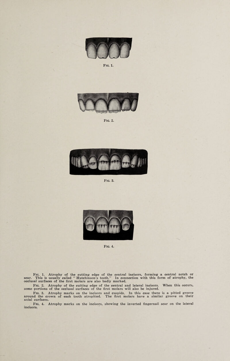 Fig. 1. Atrophy of the cutting edge of the central incisors, forming a central notch or scar. This is usually called “ Hutchinson’s tooth.” In connection with this form of atrophy, the occlusal surfaces of the first molars are also badly marked. Fig. 2. Atrophy of the cutting edge of the central and lateral incisors. When this occurs, some portions of the occlusal surfaces of the first molars will also be injured. Fig. 3. Atrophy marks on the incisors and cuspids. In this case there is a pitted groove around the crown of each tooth atrophied. The first molars have a similar groove on their axial surfaces. Fig. 4. Atrophy marks on the incisors, showing the inverted fingernail scar on the lateral incisors.