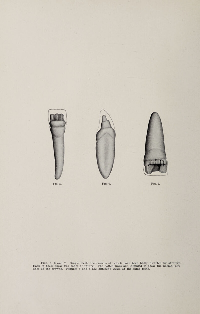 Figs. 5, 6 and 7. Single teeth, the crowns of which have been badly dwarfed by atrophy. Each of these show two zones of injury. The dotted lines are intended to show the normal out¬ lines of the crowns. Figures 5 and 6 are different views of the same tooth.