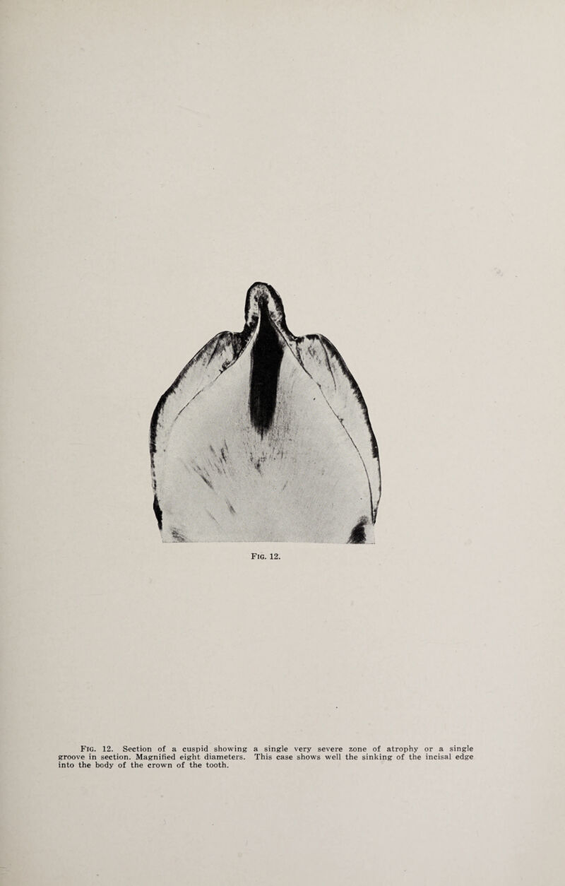 Fig. 12. Section of a cuspid showing a single very severe zone of atrophy or a single groove in section. Magnified eight diameters. This case shows well the sinking of the incisal edge into the body of the crown of the tooth.