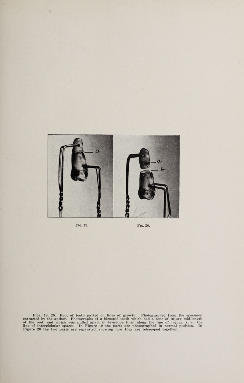 Figs. 19, 20. Root of tooth parted on lines of growth. Photographed from the specimen extracted by the author. Photographs of a bicuspid tooth which had a zone of injury mid-length of the root, and which was pulled apart in telescope form along the line of injury, i. e., the line of interglobular spaces. In Figure 19 the parts are photographed in normal position. In Figure 20 the two parts are separated, showing how they are telescoped together.