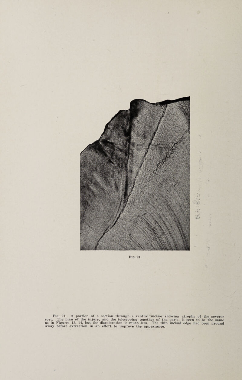 Fig. 21. A portion of a section through a central’incisor showing atrophy of the severer sort. The plan of the injury, and the telescoping together of the parts, is seen to be the same as in Figures 13, 14, but the discoloration is much less. The thin incisal edge had been ground away before extraction in an effort to improve the appearance.