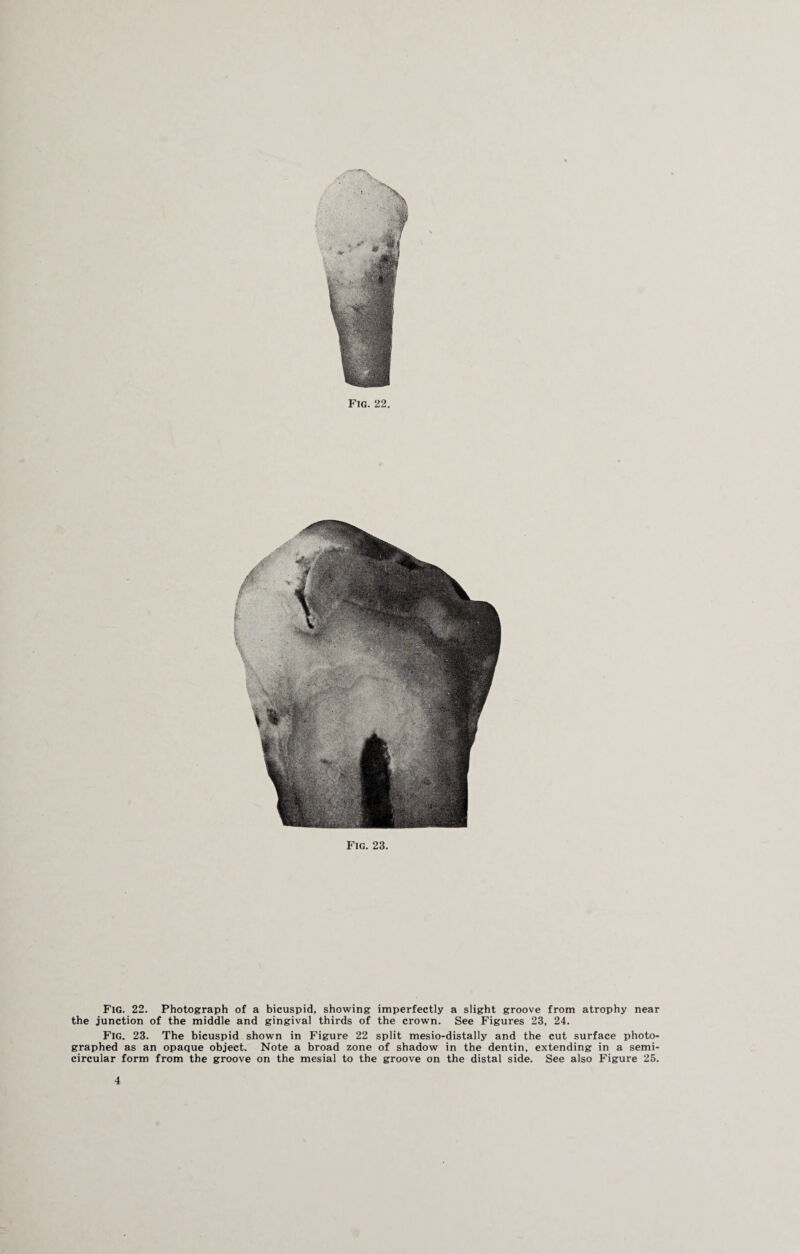 Fig. 22. Photograph of a bicuspid, showing imperfectly a slight groove from atrophy near the junction of the middle and gingival thirds of the crown. See Figures 23, 24. Fig. 23. The bicuspid shown in Figure 22 split mesio-distally and the cut surface photo¬ graphed as an opaque object. Note a broad zone of shadow in the dentin, extending in a semi¬ circular form from the groove on the mesial to the groove on the distal side. See also Figure 25. 4