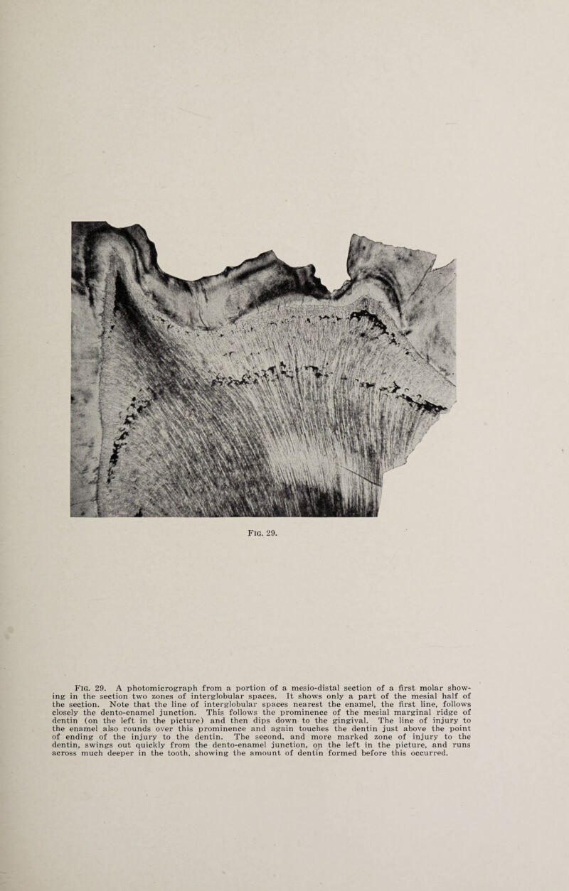 Fig. 29. A photomicrograph from a portion of a mesio-distal section of a first molar show¬ ing in the section two zones of interglobular spaces. It shows only a part of the mesial half of the section. Note that the line of interglobular spaces nearest the enamel, the first line, follows closely the dento-enamel junction. This follows the prominence of the mesial marginal ridge of dentin (on the left in the picture) and then dips down to the gingival. The line of injury to the enamel also rounds over this prominence and again touches the dentin just above the point of ending of the injury to the dentin. The second, and more marked zone of injury to the dentin, swings out quickly from the dento-enamel junction, on the left in the picture, and runs across much deeper in the tooth, showing the amount of dentin formed before this occurred.