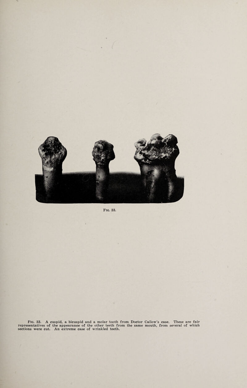 Fig. 33. A cuspid, a bicuspid and a molar tooth from Doctor Callow’s case. These are fair representatives of the appearance of the other teeth from the same mouth, from several of which sections were cut. An extreme case of wrinkled teeth.