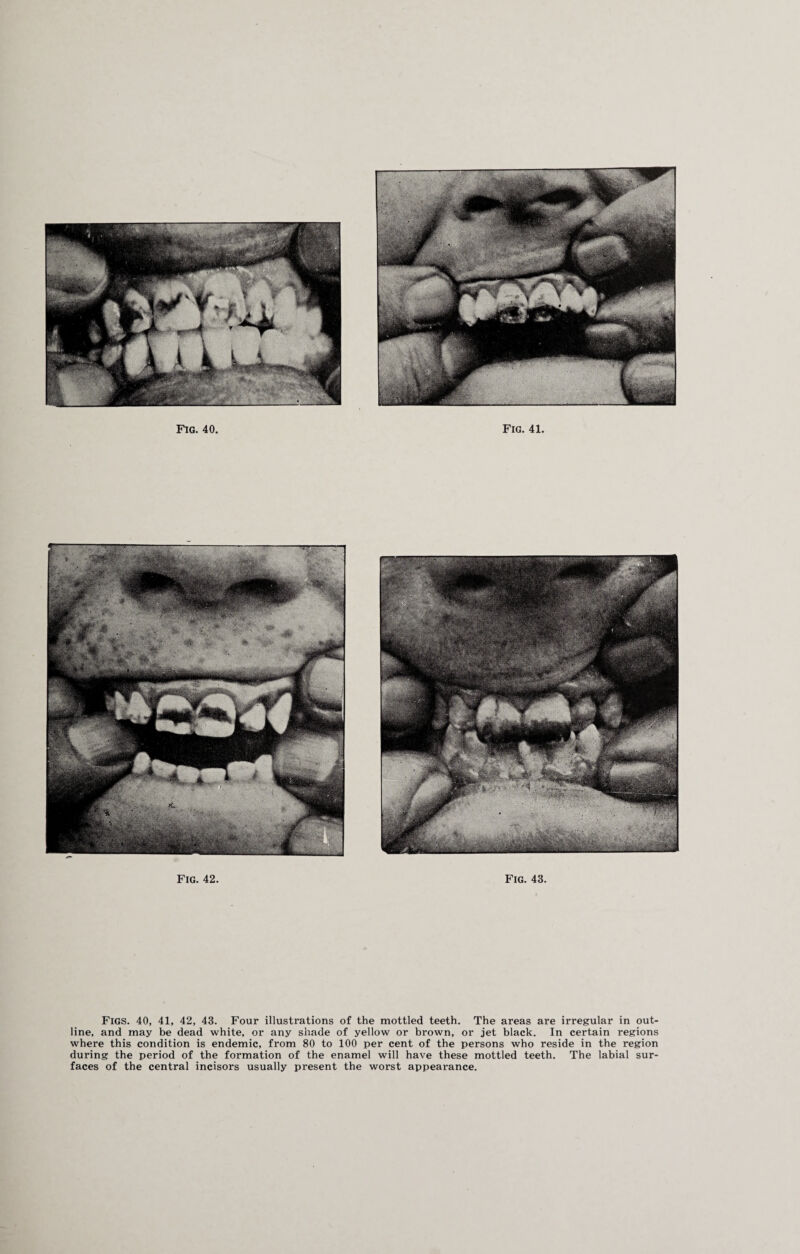 Fig. 42. Fig. 43. Figs. 40, 41, 42, 43. Four illustrations of the mottled teeth. The areas are irregular in out¬ line, and may be dead white, or any shade of yellow or brown, or jet black. In certain regions where this condition is endemic, from 80 to 100 per cent of the persons who reside in the region during the period of the formation of the enamel will have these mottled teeth. The labial sur¬ faces of the central incisors usually present the worst appeai-ance.