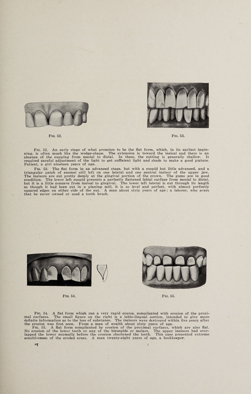 Fig. 52. An early stage of what promises to be the flat form, which, in its earliest begin¬ ning, is often much like the wedge-shape. The extension is toward the incisal and there is an absence of the cupping from mesial to distal. In these, the cutting is generally shallow. It required careful adjustment of the light to get sufficient light and shade to make a good picture. Patient, a girl nineteen years of age. Fig. 53. The flat form in an advanced stage, but with a cuspid but little advanced, and a triangular patch of enamel still left on one lateral and one central incisor of the upper jaw. The incisors are cut pretty deeply at the gingival portion of the crown. The gums are in good condition. The lower left cuspid presents a perfectly flattened labial surface from mesial to distal, but it is a little concave from incisal to gingival. The lower left lateral is cut through its length as though it had been cut in a planing mill, it is so level and perfect, with almost perfectly squared edges on either side of the cut. A man about sixty years of age ; a laborer, who avers that he never owned or used a tooth brush. Fig. 54. Fig. 55. Fig. 54. A flat form which ran a very rapid course, complicated with erosion of the proxi¬ mal surfaces. The small figure on the right is a labio-lingual section, intended to give more definite information as to the loss of substance. The incisors were destroyed within five years after the erosion was first seen. From a man of wealth about sixty years of age. Fig. 55. A flat form complicated by erosion of the proximal surfaces, which are also flat. No erosion of the lower teeth or any of the bicuspids or molars. The upper incisors had over¬ lapped the lower normally before the erosion shortened the teeth. This case presented extreme sensitiveness of the eroded areas. A man twenty-eight years of age, a bookkeeper. *7 I