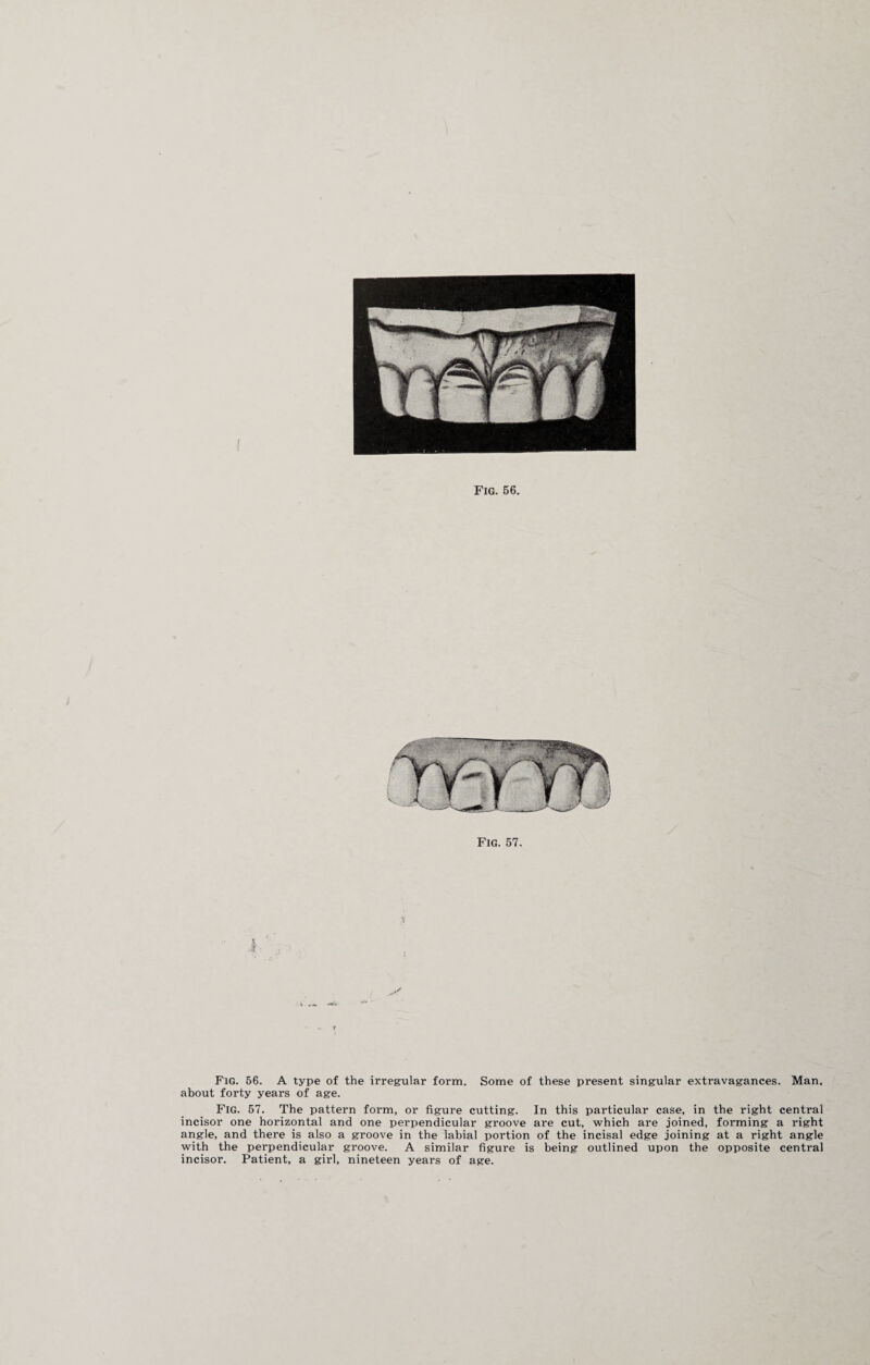 Fig. 57. V — Fig. 56. A type of the irregular form. Some of these present singular extravagances. Man. about forty years of age. Fig. 57. The pattern form, or figure cutting. In this particular case, in the right central incisor one horizontal and one perpendicular groove are cut, which are joined, forming a right angle, and there is also a groove in the labial portion of the incisal edge joining at a right angle with the perpendicular groove. A similar figure is being outlined upon the opposite central incisor. Patient, a girl, nineteen years of age.