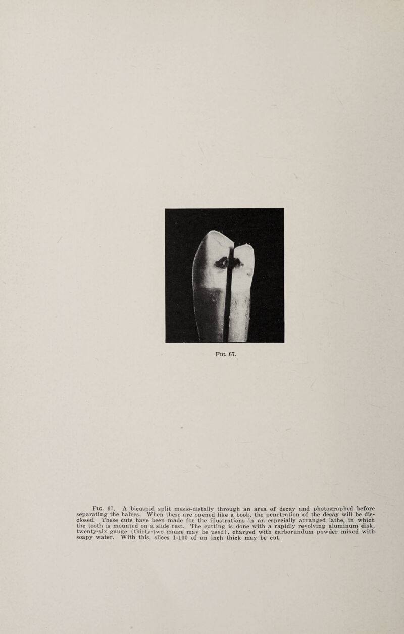 Fig. 67. A bicuspid split mesio-distally through an area of decay and photographed before separating the halves. When these are opened like a book, the penetration of the decay will be dis¬ closed. These cuts have been made for the illustrations in an especially arranged lathe, in which the tooth is mounted on a slide rest. The cutting is done with a rapidly revolving aluminum disk, twenty-six gauge (thirty-two gauge may be used), charged with carborundum powder mixed with soapy water. With this, slices 1-100 of an inch thick may be cut.