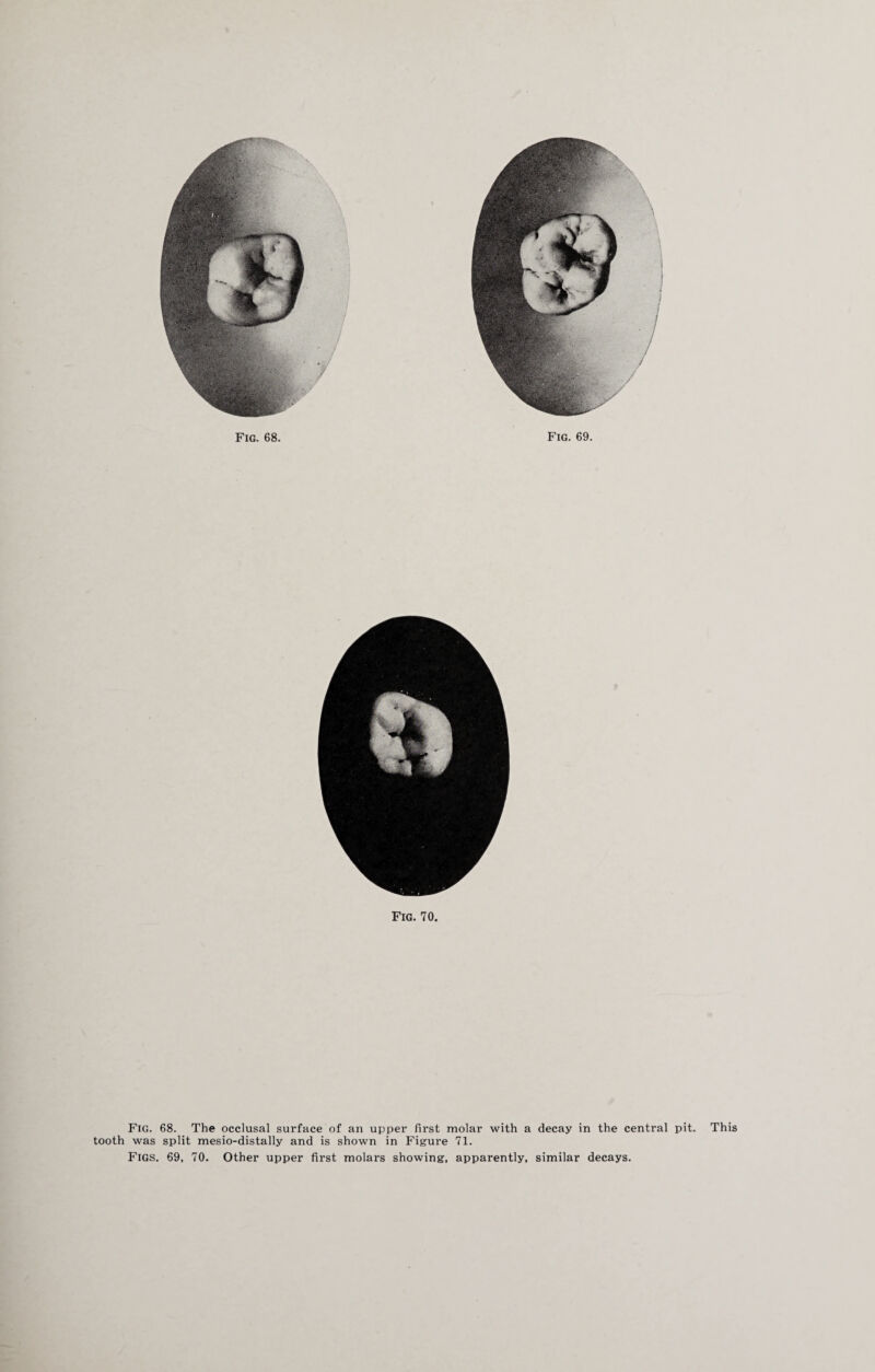 Fig. 68. The occlusal surface of an upper first molar with a decay in the central pit. This tooth was split mesio-distally and is shown in Figure 71. Figs. 69, 70. Other upper first molars showing, apparently, similar decays.