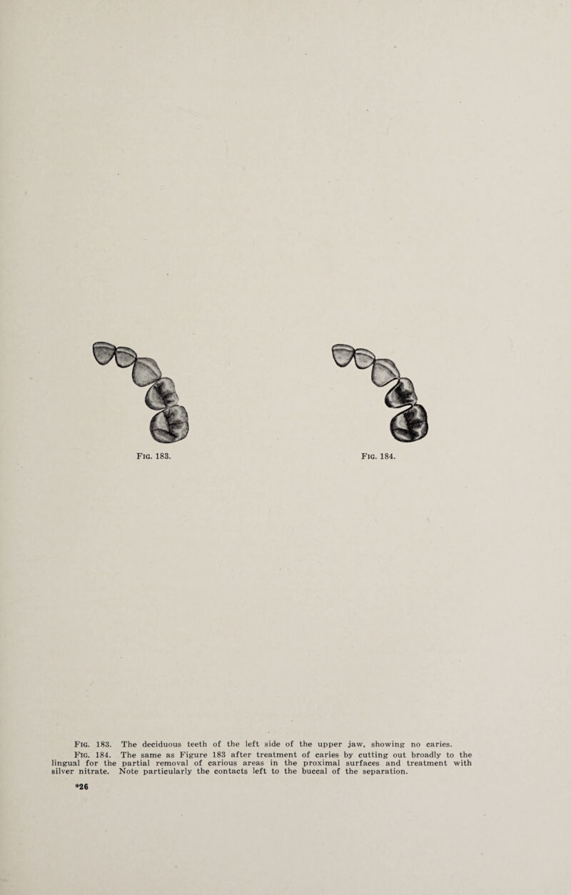 Fig. 183. The deciduous teeth of the left side of the upper jaw, showing no caries. Fig. 184. The same as Figure 183 after treatment of caries by cutting out broadly to the lingual for the partial removal of carious areas in the proximal surfaces and treatment with silver nitrate. Note particularly the contacts left to the buccal of the separation. *26