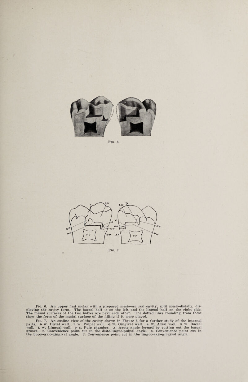 Fig. 6. An upper first molar with a prepared mesio-occlusal cavity, split mesio-distally, dis¬ playing the cavity form. The buccal half is on the left and the lingual half on the right side. The mesial surfaces of the two halves are next each other. The dotted lines rounding from these show the form of the mesial surface of the filling if it were placed. Fig. 7. An outline view of the cavity shown in Figure 6 for a further study of the internal parts. D w. Distal wall, p w. Pulpal wall. G w. Gingival wall. A w. Axial wall. B w. Buccal wall. L w. Lingual wall, p c. Pulp chamber, a. Acute angle formed by cutting out the buccal groove, d. Convenience point cut in the disto-linguo-pulpal angle. B. Convenience point cut in the bucco-axio-gingival angle, c. Convenience point cut in the linguo-axio-gingival angle.