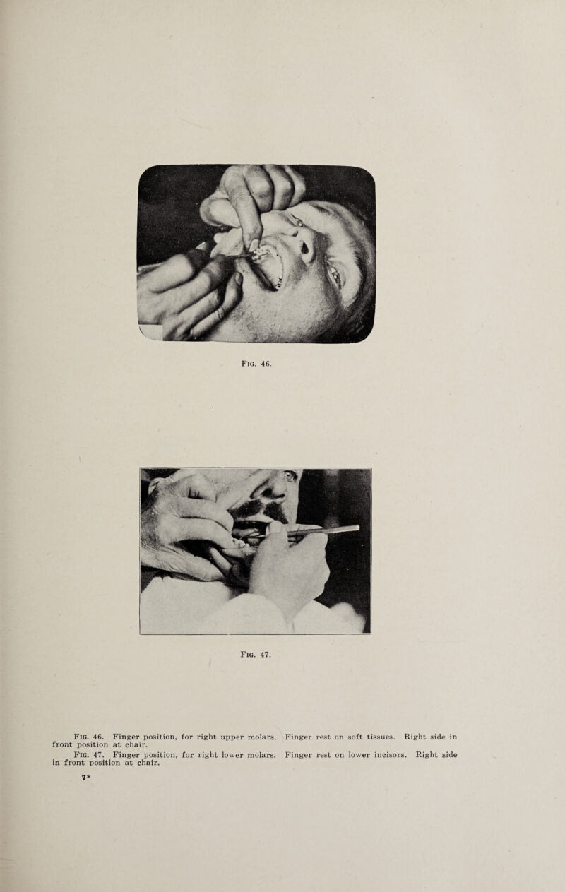 Fig. 47. Fig. 46. Finger position, for right upper molars. Finger rest on soft tissues. Right side in front position at chair. Fig. 47. Finger position, for right lower molars. Finger rest on lower incisors. Right side in front position at chair. 7*