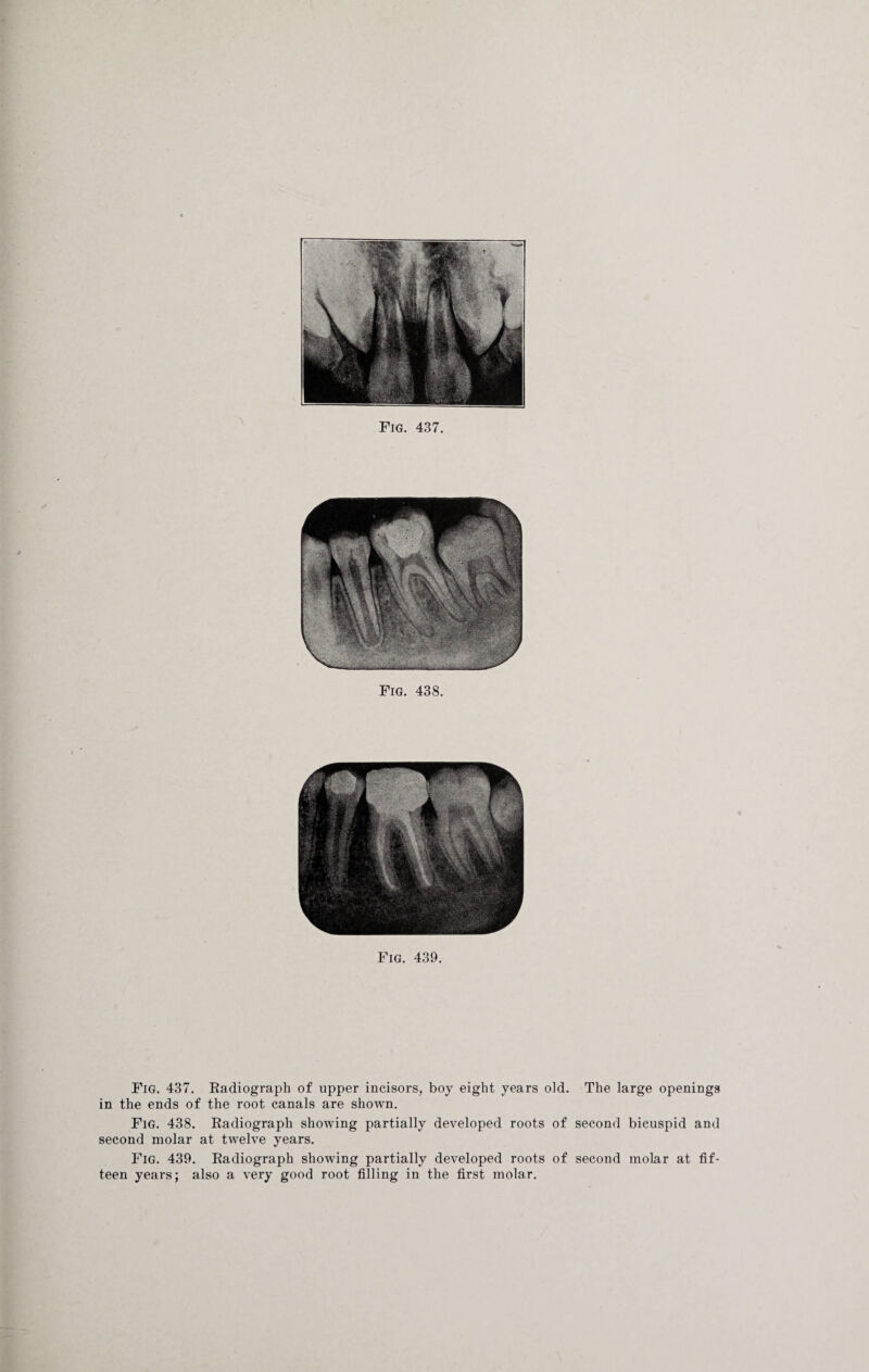 Fig. 438. Fig. 439. Fig. 437. Radiograph of upper incisors, boy eight years old. The large openings in the ends of the root canals are shown. Fig. 438. Radiograph showing partially developed roots of second bicuspid and second molar at twelve years. Fig. 439. Radiograph showing partially developed roots of second molar at fif¬ teen years; also a very good root filling in the first molar.