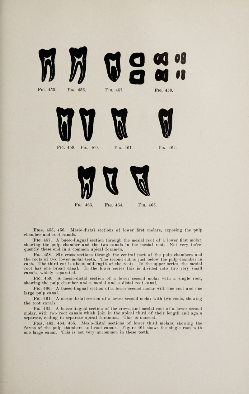 «gs:: Fig. 455. Fig. 456. Fig. 457. Fig. 458. Fig. 450. Fig. 460. Fig. 461. Fig. 462. Fig. 463. Fig. 464. Fig. 465. Figs. 455, 456. Mesio-distal sections of lower first molars, exposing the pulp chamber and root canals. Fig. 457. A bucco-lingual section through the mesial root of a lower first molar, showing the pulp chamber and the two canals in the mesial root. Not very infre¬ quently these end in a common apical foramen. Fig. 458. Six cross sections through the central part of the pulp chambers and the roots of two lower molar teeth. The second cut is just below the pulp chamber in each. The third cut is about midlength of the roots. In the upper series, the mesial root has one broad canal. In the lower series this is divided into two very small canals, widely separated. Fig. 459. A mesio-distal section of a lower second molar with a single root, showing the pulp chamber and a mesial and a distal root canal. Fig. 460. A bucco-lingual section of a lower second molar with one root and one large pulp canal. Fig. 461. A mesio-distal section of a lower second molar with two roots, showing the root canals. Fig. 462. A bucco-lingual section of the crown and mesial root of a lower second molar, with two root canals which join in the apical third of their length and again separate, ending in separate apical foramina. This is unusual. Figs. 463, 464, 465. Mesio-distal sections of lower third molars, showing the forms of the pulp chambers and root canals. Figure 464 shows the single root with one large canal. This is not very uncommon in these teeth.