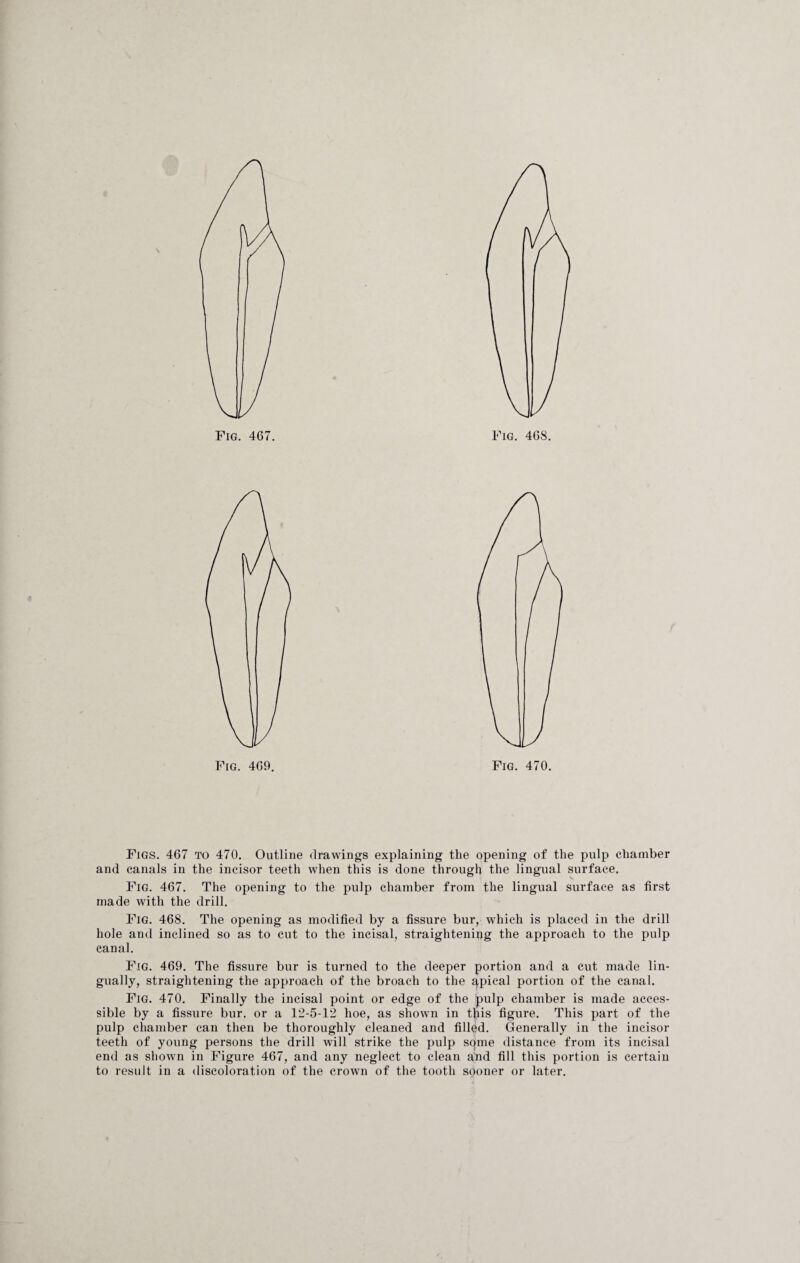 and canals in the incisor teeth when this is done through the lingual surface. Fig. 467. The opening to the pulp chamber from the lingual surface as first made with the drill. Fig. 468. The opening as modified by a fissure bur, which is placed in the drill hole and inclined so as to cut to the incisal, straightening the approach to the pulp canal. Fig. 469. The fissure bur is turned to the deeper portion and a cut made lin- gually, straightening the approach of the broach to the npical portion of the canal. Fig. 470. Finally the incisal point or edge of the pulp chamber is made acces¬ sible by a fissure bur, or a 12-5-12 hoe, as shown in tjiis figure. This part of the pulp chamber can then be thoroughly cleaned and filled. Generally in the incisor teeth of young persons the drill will strike the pulp sqme distance from its incisal end as shown in Figure 467, and any neglect to clean and fill this portion is certain to result in a discoloration of the crown of the tooth sooner or later.