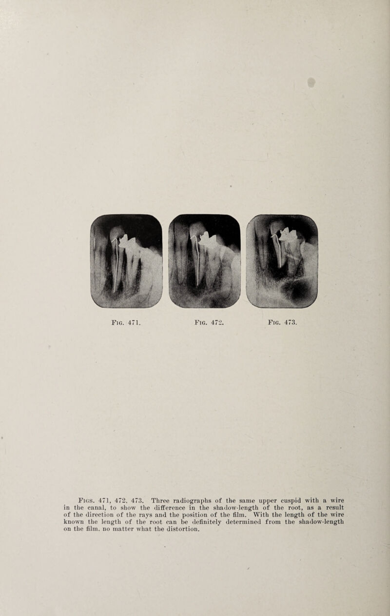 Figs. 471, 472, 473. Three radiographs of the same upper cuspid with a wire in the canal, to show the difference in the shadow-length of the root, as a result of the direction of the rays and the position of the film. With the length of the wire known the length of the root can be definitely determined from the shadow-length on the film, no matter what the distortion. /