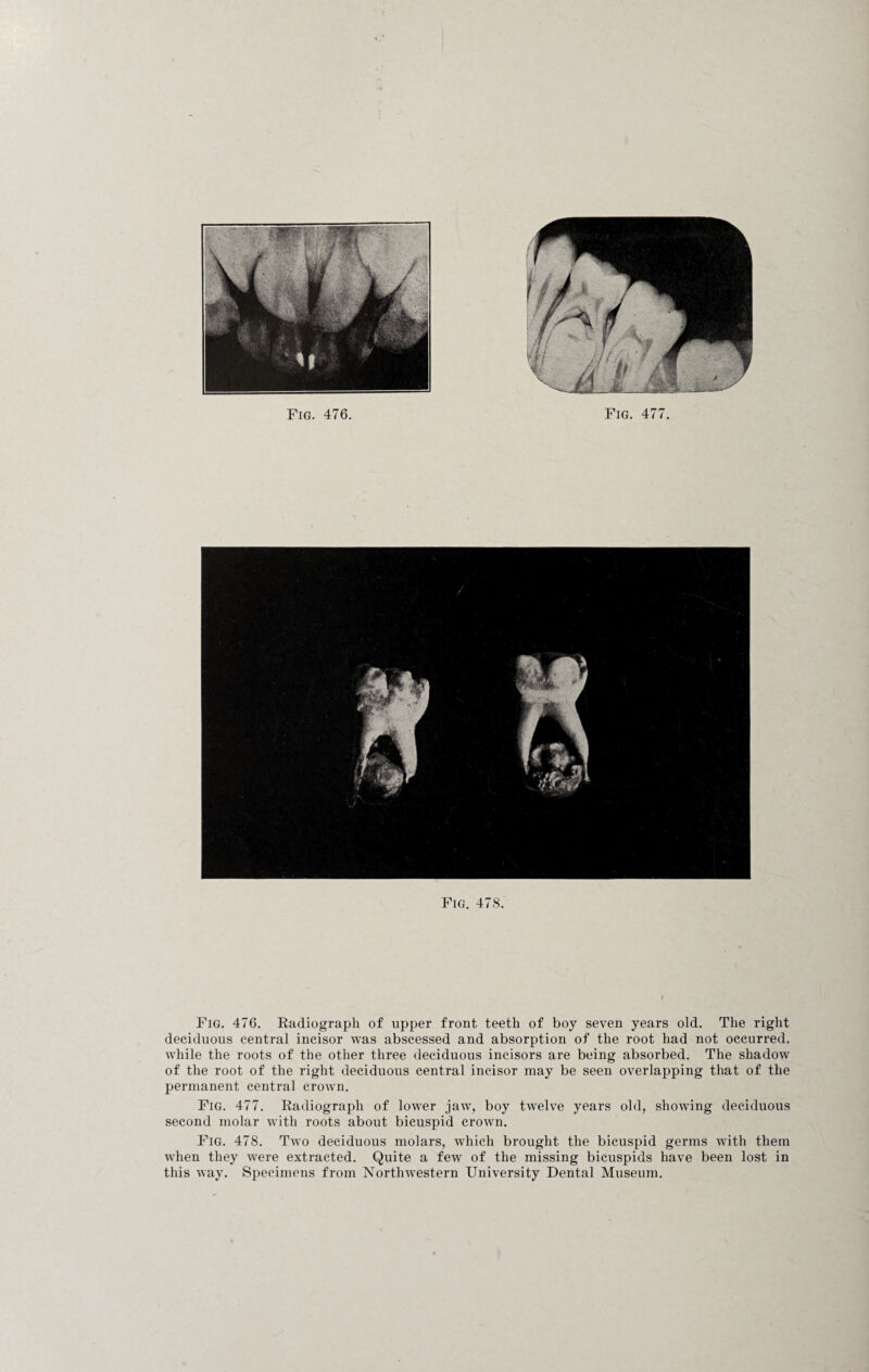 Fig. 478. Fig. 476. Radiograph of upper front teeth of boy seven years old. The right deciduous central incisor was abscessed and absorption of the root had not occurred, while the roots of the other three deciduous incisors are being absorbed. The shadow of the root of the right deciduous central incisor may be seen overlapping that of the permanent central crown. Fig. 477. Radiograph of lower jaw, boy twelve years old, showing deciduous second molar with roots about bicuspid crown. Fig. 478. Two deciduous molars, which brought the bicuspid germs with them when they were extracted. Quite a few of the missing bicuspids have been lost in this way. Specimens from Northwestern University Dental Museum.