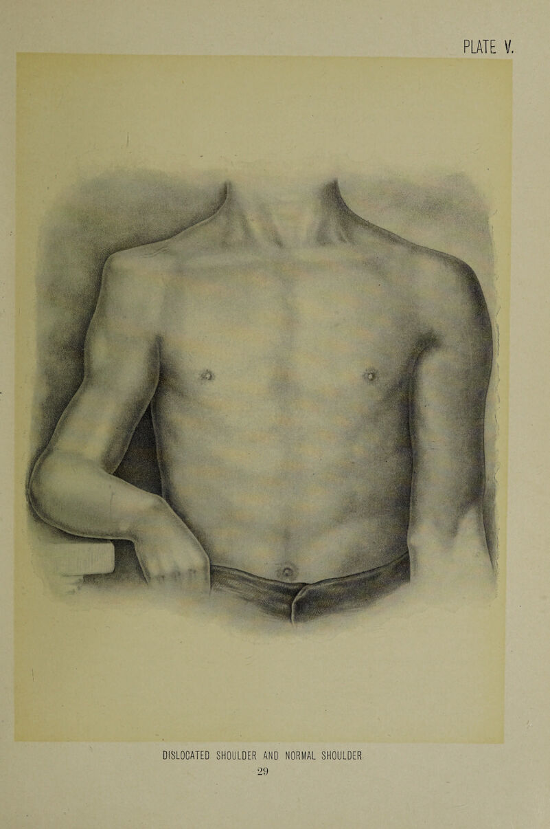 DISLOCATED SHOULDER AND NORMAL SHOULDER