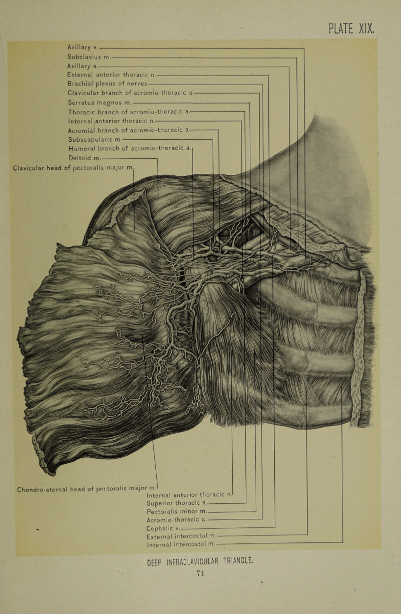 Axillary v.- Subclavius m.-*- Axillary a.- External anterior thoracic n.- Brachial plexus of nerves- Clavicular branch of acromio-thoracic a.- Serratus magnus m.-- Thoracic branch of acrpmio-thoracic a.— Internal anterior thoracic n.- Acromial branch of acromio-thoracic a,— Subscapularis m.- Humeral branch of acromio-thoracic Deltoid m.- Clavicular head of pectoralis major m Chondro- sternal head of pectoralis major m, Internal anterior thoracic Superior thoracic a- Pectoralis minor m- Acromio-thoracic a.- Cephalic v.--- External intercostal m.- Internal intercostal m.- n DEEP INFRACLAV1CULAR TRIANGLE,
