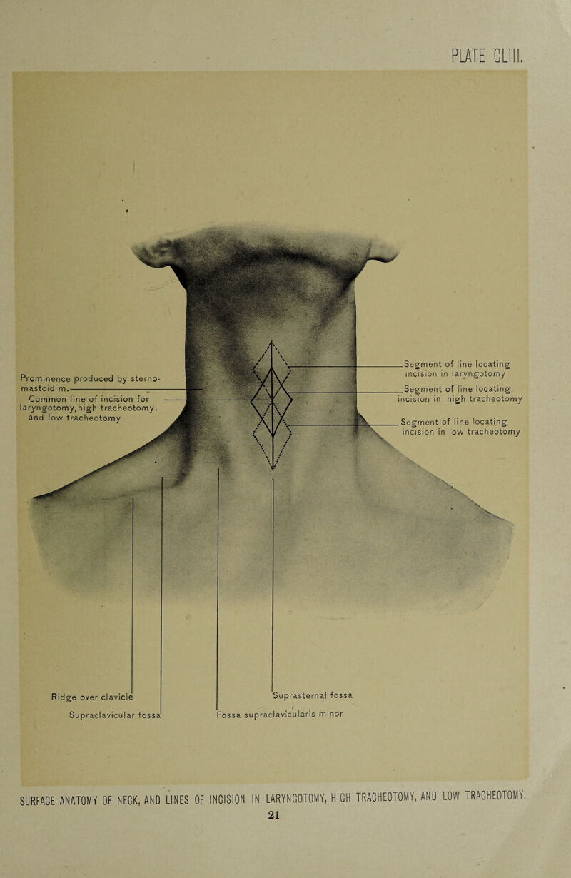 Prominence produced by sterno mastoid m.-;— Common line of incision for laryngotomy, high tracheotomy, and low tracheotomy Segment of line locating incision in laryngotomy Segment of line locating incision in high tracheotomy Segment of line locating incision in low tracheotomy Ridge over clavicle Suprasternal fossa Supraclavicular fossa ossa supraclavlcularis minor SURFACE ANATOMY OF NECK, AND LINES OF INCISION LARYNCOTOMY, HICH TRACHEOTOMY, AND LOW TRACHEOTOMY.