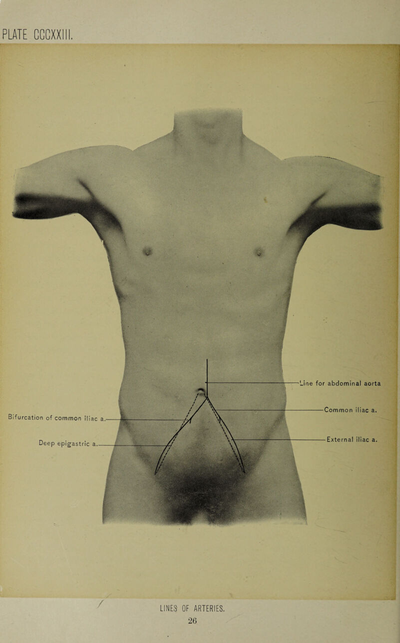 Line for abdominal aorta Common iliac a Bifurcation of common iliac a External iliac a Deep epigastric a / LINES OF ARTERIES