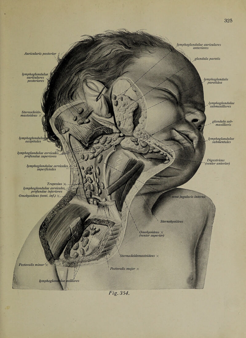Auricularis posterior j /' lymphoglandulae auriculares lymphoglandiilae auriculares anteriores glandula parotis posteriores Sternocleido- mastoideus X Pectoralis minor A/.. L„ lymphoglandulae occipitales lymphoglandulae cervicales profundae superiores \ \g\ lymphoglandulae cervicales jXfS Trapezius X- lymphoglandulae cervicales\ profundae inferiores Omohyoideus (vent, inf.) \ lymphoglandula ' parotidea lymphoglandulae submaxillares glandula sub- maxillaris lymphoglandulae submentales ~ ~ Digastricus ' SSffigT '(venter anterior) '-■vena jugularis interna ' Sternohyoideus M 1 Omohyoideus X (venter superior) Sternocleidomastoideus x / m Pectoralis major x lymphoglandtdae axillares