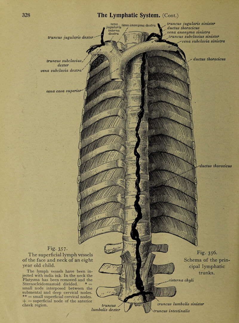 vena . vena truncus jugularis dexter Iruncus subclavius/ dexter / vena subclavia dexlra/ vena cava superior anonyma dextra \ ^ truncus jugularis sinister . ductus thoracicus vena anonyma sinistra lruncus subclavius sinister vena subclavia sinistra ductus thoracicus Fig- 3.5 7• The superficial lymph vessels of the face and neck of an eight year old child. The lymph vessels have been in¬ jected with india ink. In the neck the Platysma has been removed and the Sternocleidomastoid divided. * = small node interposed between the submental and deep cervical nodes. ** = small superficial cervical nodes. + = superficial node of the anterior cheek region. ductus thoracicus Fig. 356. Schema of the prin¬ cipal lymphatic trunks. __cisterna chyli truncus s lumbalis dexter Iruncus lumbalis sinister \truncus intestinalis