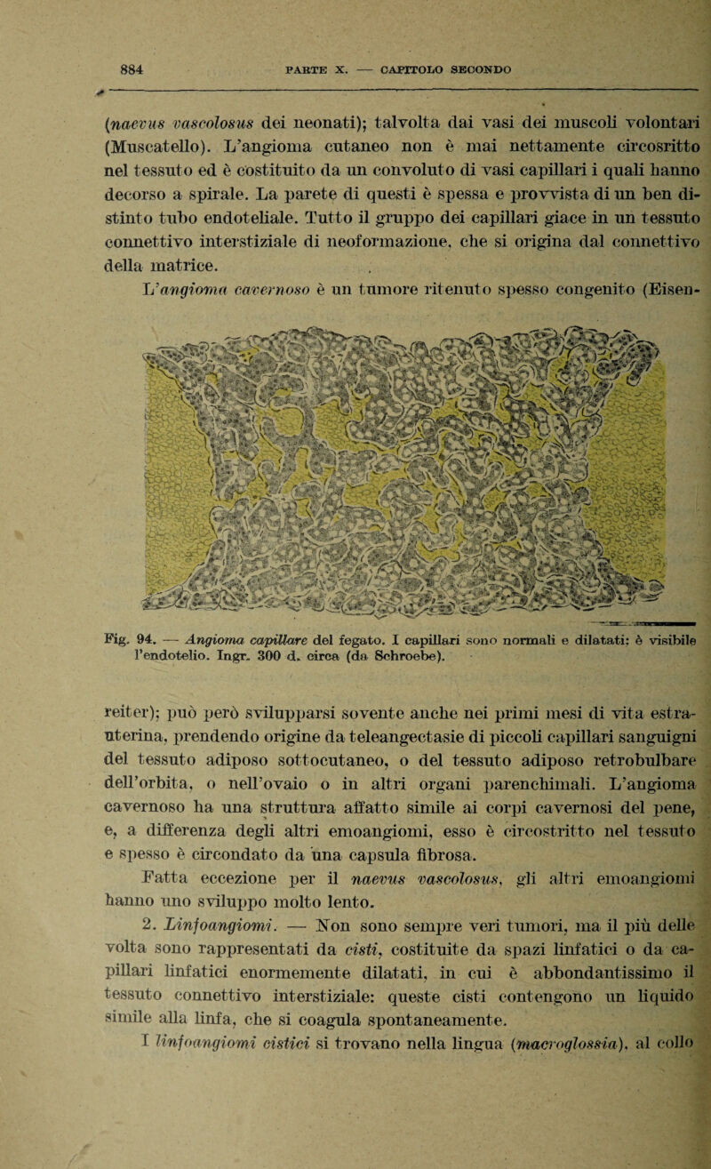 (naevus vascolosus dei neonati); talvolta dai vasi dei muscoli volontari (Moscatello). L’angioma cutaneo non è mai nettamente circosritto nel tessuto ed è costituito da un convoluto di vasi capillari i quali hanno decorso a spirale. La parete di questi è spessa e provvista di un ben di¬ stinto tubo endoteliale. Tutto il gruppo dei capillari giace in un tessuto connettivo interstiziale di neoformazione, che si origina dal connettivo della matrice. Ir a ngiom a cavernoso è un tumore ritenuto spesso congenito (Eiseo Fig. 94. — Angioma capillare del fegato. I capillari sono normali e dilatati; è visibile l’endotelio. Ingr. 300 d. circa (da Schroebe). reiter); può però svilupparsi sovente anche nei primi mesi di vita estra- uterina, prendendo origine da teleangectasie di piccoli capillari sanguigni del tessuto adiposo sottocutaneo, o del tessuto adiposo retrobulbare dell’orbita, o nell’ovaio o in altri organi parenchimali. L’angioma cavernoso ha una struttura affatto simile ai corpi cavernosi del pene, e, a differenza degli altri emoangiomi, esso è circostritto nel tessuto e spesso è circondato da una capsula fibrosa. Latta eccezione per il naevus vascolosus, gli altri emoangiomi hanno uno sviluppo molto lento. 2. Linfoangiomi. — Non sono sempre veri tumori, ma il più delle volta sono rappresentati da cisti, costituite da spazi linfatici o da ca¬ pillari linfatici enormemente dilatati, in cui è abbondantissimo il tessuto connettivo interstiziale: queste cisti contengono un liquido simile alla linfa, che si coagula spontaneamente. I linfoangiomi cistici si trovano nella lingua (rmcroglossia), al collo