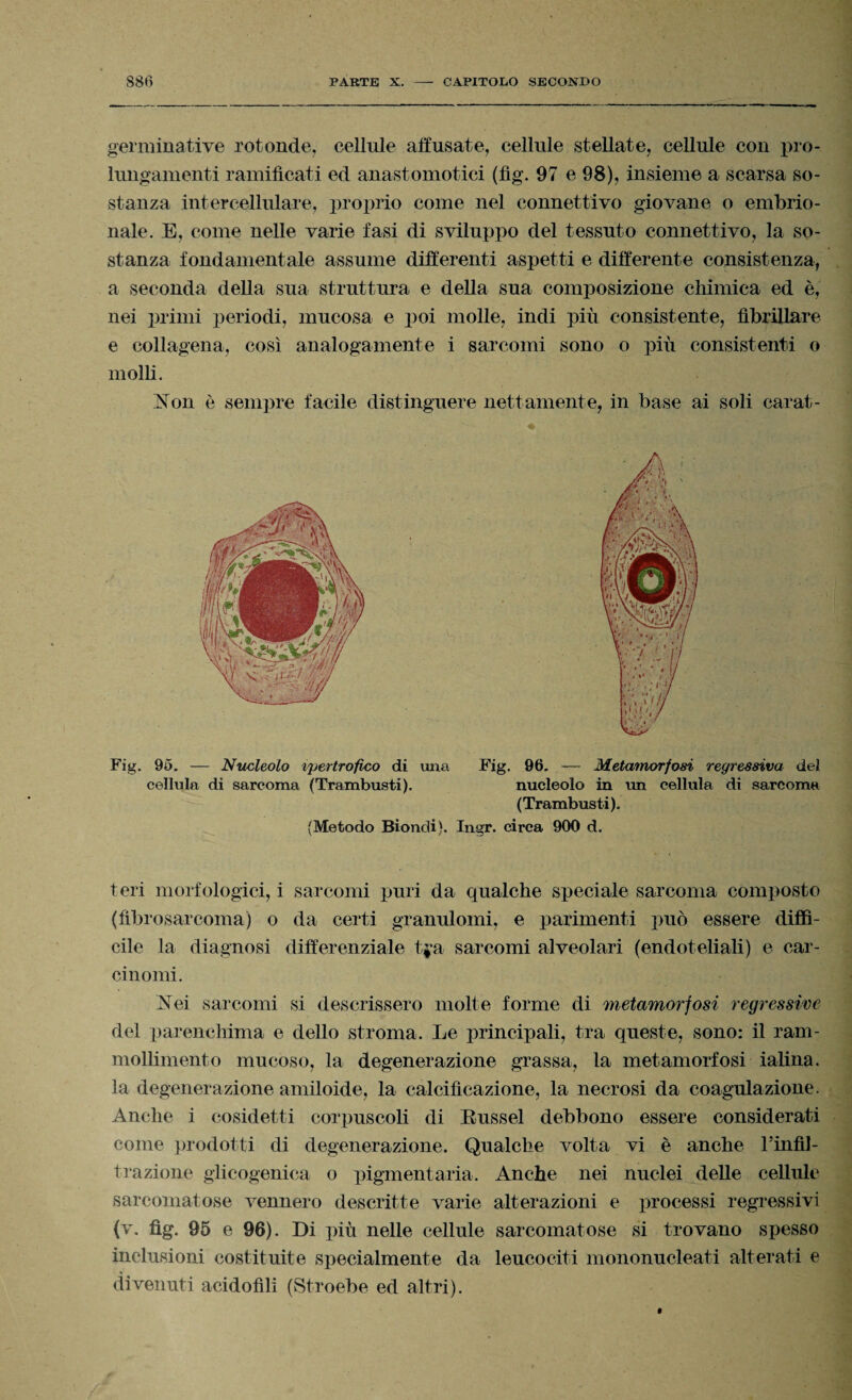 germinative rotonde, cellule affusate, cellule stellate, cellule con pro¬ lungamenti ramificati ed anastomotici (fìg. 97 e 98), insieme a scarsa so¬ stanza intercellulare, proprio come nel connettivo giovane o embrio¬ nale. E, come nelle varie fasi di sviluppo del tessuto connettivo, la so¬ stanza fondamentale assume differenti aspetti e differente consistenza, a seconda della sua struttura e della sua composizione chimica ed è, nei primi periodi, mucosa e poi molle, indi più consistente, fibrillare e collagena, così analogamente i sarcomi sono o più consistenti o molli. Non è sempre facile distinguere nettamente, in base ai soli carat- Fig. 95. — Nucleolo ipertrofico di una Fig. 96. — Metamorfosi regressiva del cellula di sarcoma (Trambusti). nucleolo in un cellula di sarcoma (Trambusti). (Metodo Biondi). Ingr. circa 900 d. teri morfologici, i sarcomi puri da qualche speciale sarcoma composto (fibrosarcoma) o da certi granulomi, e parimenti può essere diffì¬ cile la diagnosi differenziale tya sarcomi alveolari (endoteliali) e car¬ cinomi. Nei sarcomi si descrissero molte forme di metamorfosi regressive del parenchima e dello stroma. Le principali, tra queste, sono: il ram¬ mollimento mucoso, la degenerazione grassa, la metamorfosi ialina, la degenerazione amiloide, la calcificazione, la necrosi da coagulazione. Anche i cosidetti corpuscoli di Eussel debbono essere considerati come prodotti di degenerazione. Qualche volta vi è anche l'infìl- trazione glicogenica o pigmentaria. Anche nei nuclei delle cellule sarcoinatose vennero descritte varie alterazioni e processi regressivi (v. fìg. 95 e 96). Di più nelle cellule sarcoma-tose si trovano spesso inclusioni costituite specialmente da leucociti mononucleati alterati e divenuti acidofìli (Stroebe ed altri).