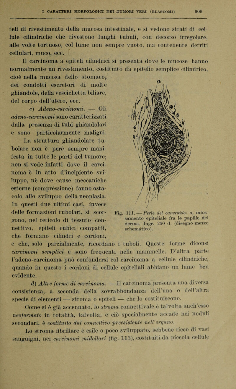 teli di rivestimento della mucosa intestinale, e si vedono strati di cel¬ lule cilindriche che rivestono lunghi tubuli, con decorso irregolare, alle volte tortuoso, col lume non sempre vuoto, ma contenente detriti cellulari, muco, ecc. Il carcinoma a epiteli cilindrici si presenta dove le mucose hanno normalmente un rivestimento, costituito da epitelio semplice cilindrico, cioè nella mucosa dello stomaco, dei condotti escretori di molte ghiandole, della vescichetta biliare, del corpo dell’utero, ecc. c) Aderto-carcinomi. — Gli adeno-carcinomi sono caratterizzati dalla presenza di tubi ghiandolari e sono particolarmente maligni. La struttura ghiandolare tu¬ bolare non è però sempre mani¬ festa in tutte le parti del tumore; non si vede infatti dove il carci¬ noma è in atto d’incipiente svi¬ luppo, nè dove cause meccaniche esterne (compressione) fanno osta¬ colo allo sviluppo della neoplasia. In questi due ultimi casi, invece delle formazioni tubolari, si scor¬ gono, nel reticolo di tessuto con¬ nettivo, epiteli cubici compatti, che formano cilindri e cordoni, e che, solo parzialmente, ricordano i tuboli. Queste forme diconsi carcinomi semplici e sono frequenti nelle mammelle. D’altra parte Fadeno-carcinoma può confondersi col carcinoma a cellule cilindriche, quando in questo i cordoni di cellule epiteliali abbiano un lume ben evidente. d) Altre forme di carcinoma. — Il carcinoma presenta una diversa consistenza, a seconda della sovrabbondanza dell'una o dell altra specie di elementi — stroma o epiteli ■— che lo costituiscono. Come si è già accennato, lo stroma connettivaie è talvolta anch’esso neoformato in totalità, talvolta, e ciò specialmente accade nei noduli secondari, è costituito dal connettivo preesistente nell organo. Lo stroma fibrillare è esile o poco sviluppato, sebbene ricco di vasi sanguigni, nei carcinomi midollari (fìg. 113), costituiti da piccola cellule & Fig. 1J1. — Perle del carteroide: a, infos¬ samento epiteliale fra le papille del derma. Ingr. 250 d. (disegno mezzo schemàtico).