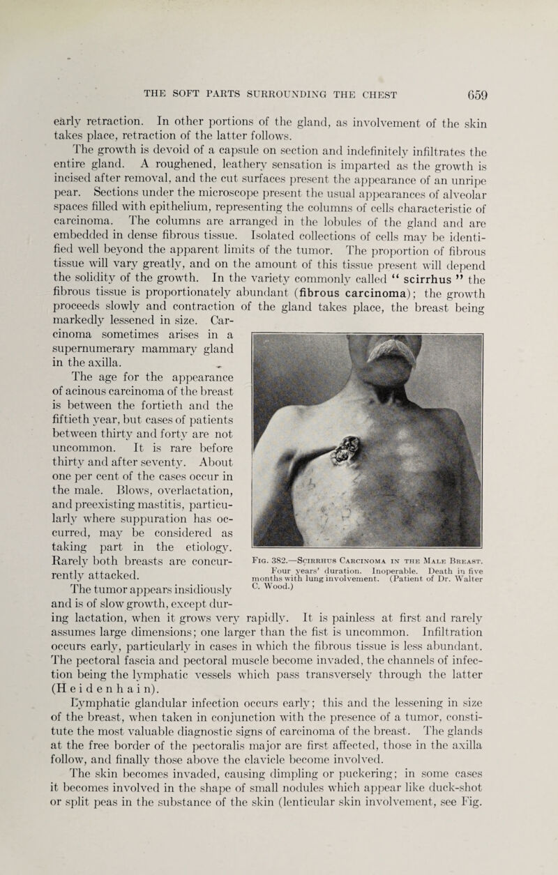 early retraction. In other portions of the gland, as involvement of the skin takes place, retraction of the latter follows. The growth is devoid of a capsule on section and indefinitely infiltrates the entire gland. A roughened, leathery sensation is imparted as the growth is incised after removal, and the cut surfaces present the appearance of an unripe pear. Sections under the microscope present the usual appearances of alveolar spaces filled with epithelium, representing the columns of cells characteristic of carcinoma. The columns are arranged in the lobules of the gland and are embedded in dense fibrous tissue. Isolated collections of cells may be identi¬ fied well beyond the apparent limits of the tumor. The proportion of fibrous tissue will vary greatly, and on the amount of this tissue present will depend the solidity of the growth. In the variety commonly called “ scirrhus ” the fibrous tissue is proportionately abundant (fibrous carcinoma); the growth proceeds slowly and contraction of the gland takes place, the breast being markedly lessened in size. Car¬ cinoma sometimes arises in a supernumerary mammary gland in the axilla. The age for the appearance of acinous carcinoma of the breast is between the fortieth and the fiftieth year, but cases of patients between thirty and forty are not uncommon. It is rare before thirty and after seventy. About one per cent of the cases occur in the male. Blows, overlactation, and preexisting mastitis, particu¬ larly where suppuration has oc¬ curred, may be considered as taking part in the etiology. Rarely both breasts are concur¬ rently attacked. The tumor appears insidiously and is of slow growth, except dur¬ ing lactation, when it grows very rapidly. It is painless at first and rarely assumes large dimensions; one larger than the fist is uncommon. Infiltration occurs early, particularly in cases in which the fibrous tissue is less abundant. The pectoral fascia and pectoral muscle become invaded, the channels of infec¬ tion being the lymphatic vessels which pass transversely through the latter (Heidenhain). Lymphatic glandular infection occurs early; this and the lessening in size of the breast, when taken in conjunction with the presence of a tumor, consti¬ tute the most valuable diagnostic signs of carcinoma of the breast. The glands at the free border of the pectoralis major are first affected, those in the axilla follow, and finally those above the clavicle become involved. The skin becomes invaded, causing dimpling or puckering; in some cases it becomes involved in the shape of small nodules which appear like duck-shot or split peas in the substance of the skin (lenticular skin involvement, see Fig. Fig. 382.—Scirrhus Carcinoma in the Male Breast. Four years’ duration. Inoperable. Death in five months with lung involvement. (Patient of Dr. Walter C. Wood.)