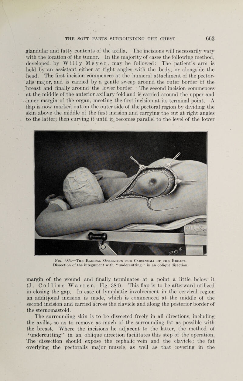 glandular and fatty contents of the axilla. The incisions will necessarily vary with the location of the tumor. In the majority of cases the following method, developed by Willy Meyer, may be followed: The patient’s arm is held by an assistant either at right angles with the body, or alongside the head. The first incision commences at the humeral attachment of the pector- alis major, and is carried by a gentle sweep around the outer border of the ‘breast and finally around the lower border. The second incision commences at the middle of the anterior axillary fold and is carried around the upper and inner margin of the organ, meeting the first incision at its terminal point. A flap is now marked out on the outer side of the pectoral region by dividing the skin above the middle of the first incision and carrying the cut at right angles to the latter, then curving it until it becomes parallel to the level of the lower Fig. 385.—The Radical Operation for Carcinoma of the Breast. Dissection of the integument with “undercutting’' in an oblique direction. margin of the wound and finally terminates at a point a little below it (J . Collins Warren, Fig. 384). This flap is to be afterward utilized in closing the gap. In case of lymphatic involvement in the cervical region an additional incision is made, which is commenced at the middle of the second incision and carried across the clavicle and along the posterior border of the sternomastoid. The surrounding skin is to be dissected freely in all directions, including the axilla, so as to remove as much of the surrounding fat as possible with the breast. Where the incisions lie adjacent to the latter, the method of “undercutting” in an oblique direction facilitates this step of the operation. The dissection should expose the cephalic vein and the clavicle; the fat overlying the pectoralis major muscle, as well as that covering in the