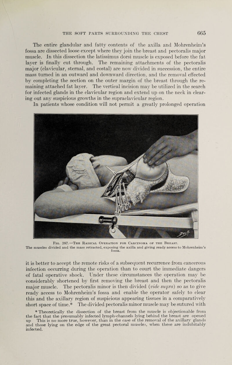 The entire glandular and fatty contents of the axilla and Mohrenheim’s fossa are dissected loose except where they join the breast and pectoralis major muscle. In this dissection the latissimus dorsi muscle is exposed before the fat layer is finally cut through. The remaining attachments of the pectoralis major (clavicular, sternal, and costal) are now divided in succession, the entire mass turned in an outward and downward direction, and the removal effected by completing the section on the outer margin of the breast through the re¬ maining attached fat layer. The vertical incision may be utilized in the search for infected glands in the clavicular region and extend up on the neck in clear¬ ing out any suspicious growths in the supraclavicular region. In patients whose condition will not permit a greatly prolonged operation Fig. 387.—The Radical Operation for Carcinoma of the Breast. The muscles divided and the mass retracted, exposing the axilla and giving ready access to Mohrenheim’s fossa. it is better to accept the remote risks of a subsequent recurrence from cancerous infection occurring during the operation than to court the immediate dangers of fatal operative shock. Under these circumstances the operation may be considerably shortened by first removing the breast and then the pectoralis major muscle. The pectoralis minor is then divided (vide supra) so as to give ready access to Mohrenheim’s fossa and enable the operator safely to clear this and the axillary region of suspicious appearing tissues in a comparatively short space of time.* The divided pectoralis minor muscle may be sutured with * Theoretically the dissection of the breast from the muscle is objectionable from the fact that the presumably infected lymph-channels lying behind the breast are opened up This is no more true, however, than in the case of the removal of the axillary glands and those lying on the edge of the great pectoral muscles, when these are indubitably infected.