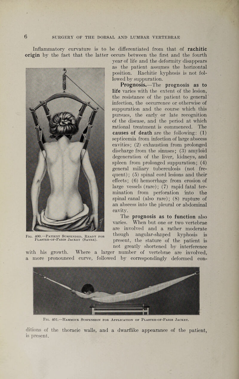 Inflammatory curvature is to be differentiated from that of rachitic origin by the fact that the latter occurs between the first and the fourth year of life and the deformity disappears as the patient assumes the horizontal position. Rachitic kyphosis is not fol¬ lowed by suppuration. Prognosis.—The prognosis as to life varies with the extent of the lesion, the resistance of the patient to general infection, the occurrence or otherwise of suppuration and the course which this pursues, the early or late recognition of the disease, and the period at which rational treatment is commenced. The causes of death are the following: (1) septicemia from infection of large abscess cavities; (2) exhaustion from prolonged discharge from the sinuses; (3) amyloid degeneration of the liver, kidneys, and spleen from prolonged suppuration; (4) general miliary tuberculosis (not fre¬ quent) ; (5) spinal cord lesions and their effects; (6) hemorrhage from erosion of large vessels (rare); (7) rapid fatal ter¬ mination from perforation into the spinal canal (also rare); (8) rupture of an abscess into the pleural or abdominal cavity. The prognosis as to function also varies. When but one or two vertebrae are involved and a rather moderate though angular-shaped kyphosis is present, the stature of the patient is not greatly shortened by interference with his growth. Where a larger number of vertebrae are involved, a more pronounced curve, followed by correspondingly deformed con- Fig. 400.—Patient Suspended, Ready for Plaster-of-Paris Jacket (Sayre). Fig. 401.—Hammock Suspension for Application of Plaster-of-Paris Jacket. ditions of the thoracic walls, and a dwarflike appearance of the patient, is present.